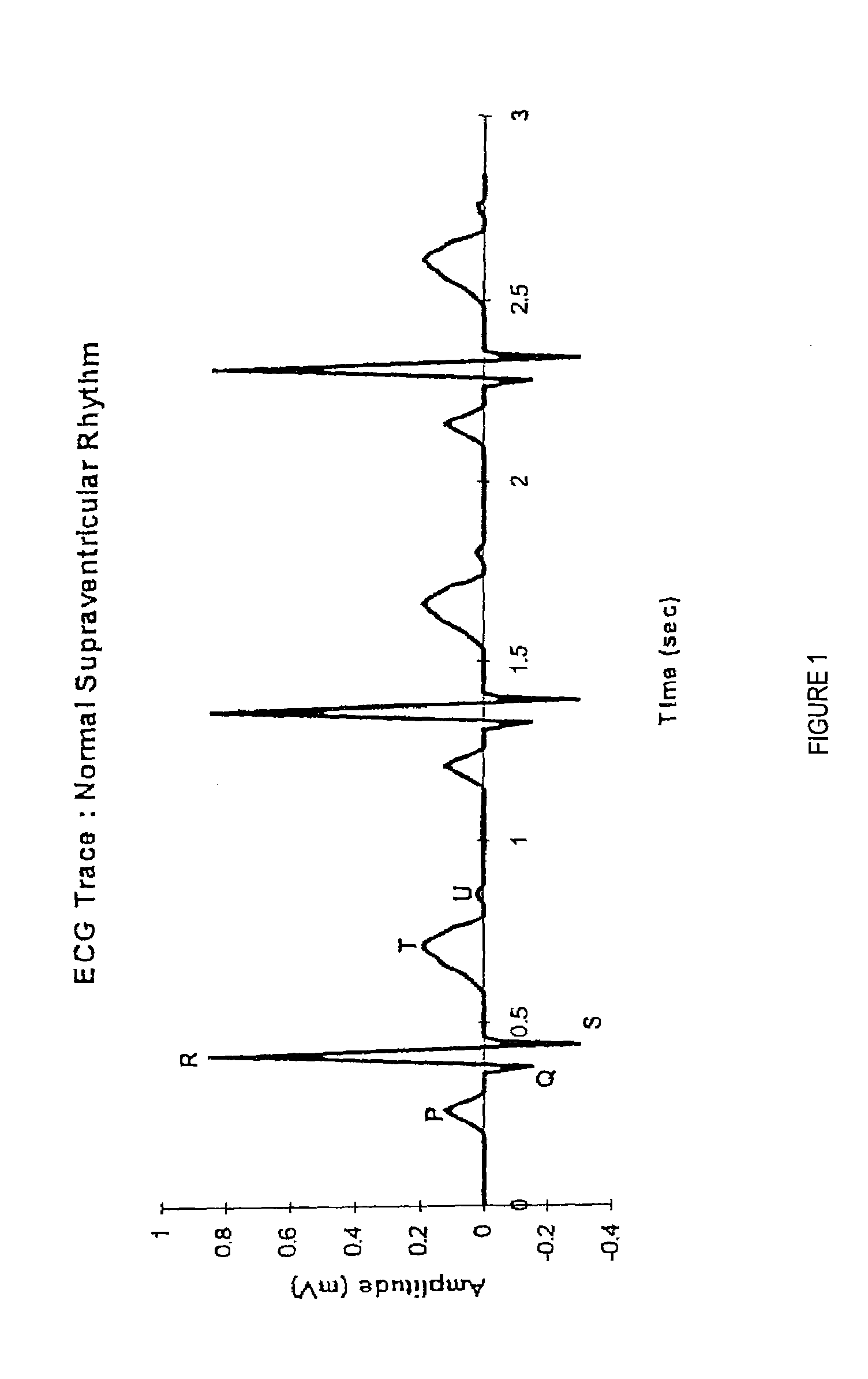Method and system for processing electrocardial signals