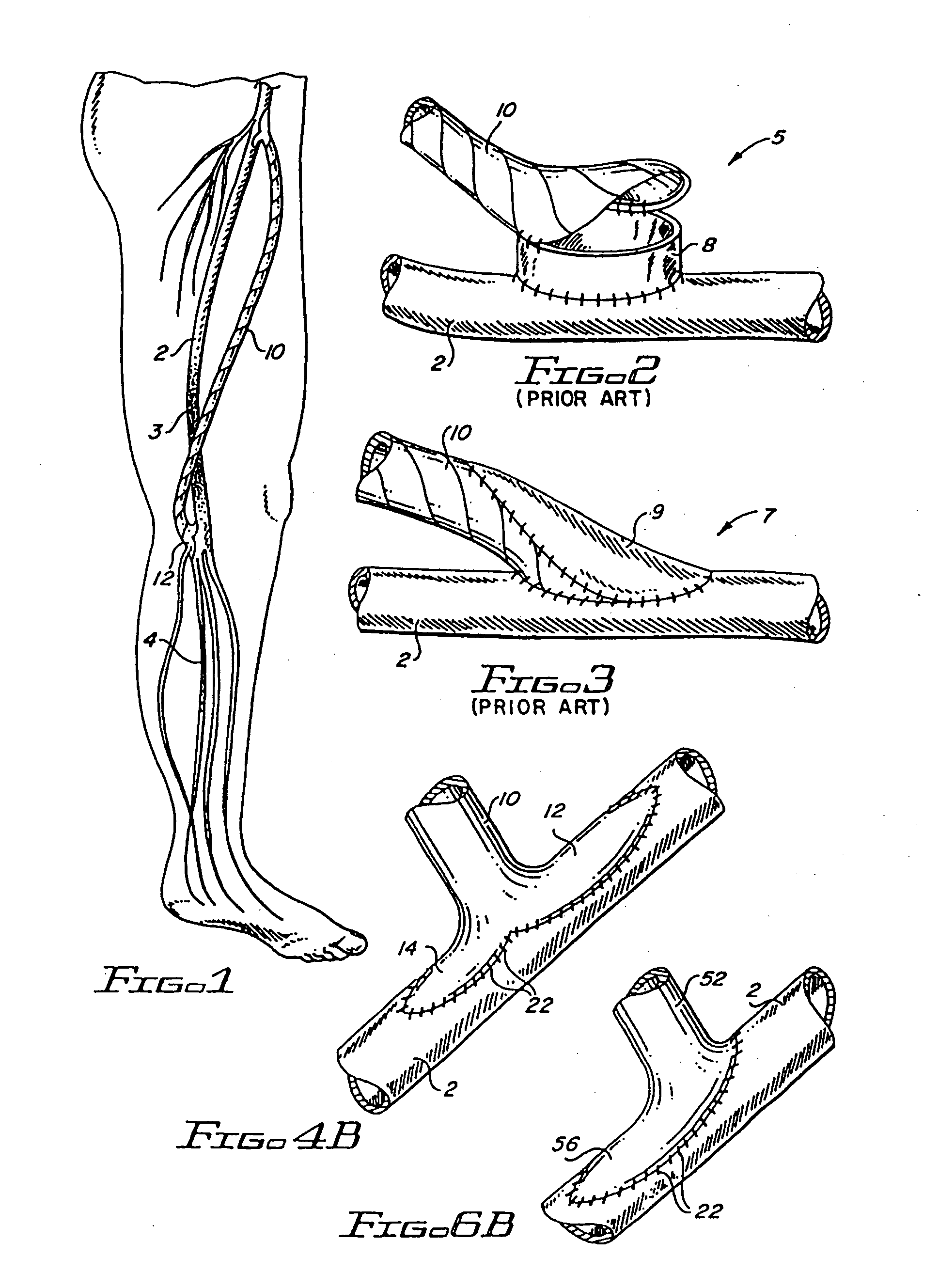 Flanged graft for end-to-side anastomosis