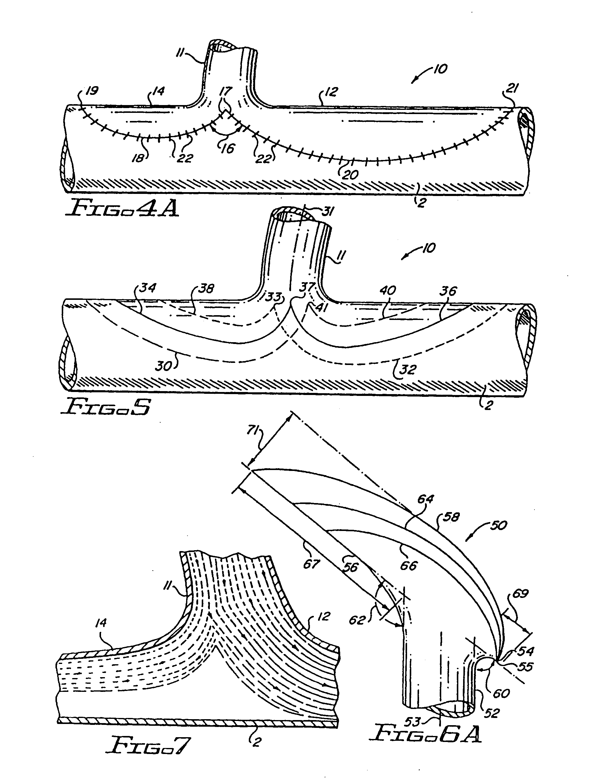 Flanged graft for end-to-side anastomosis