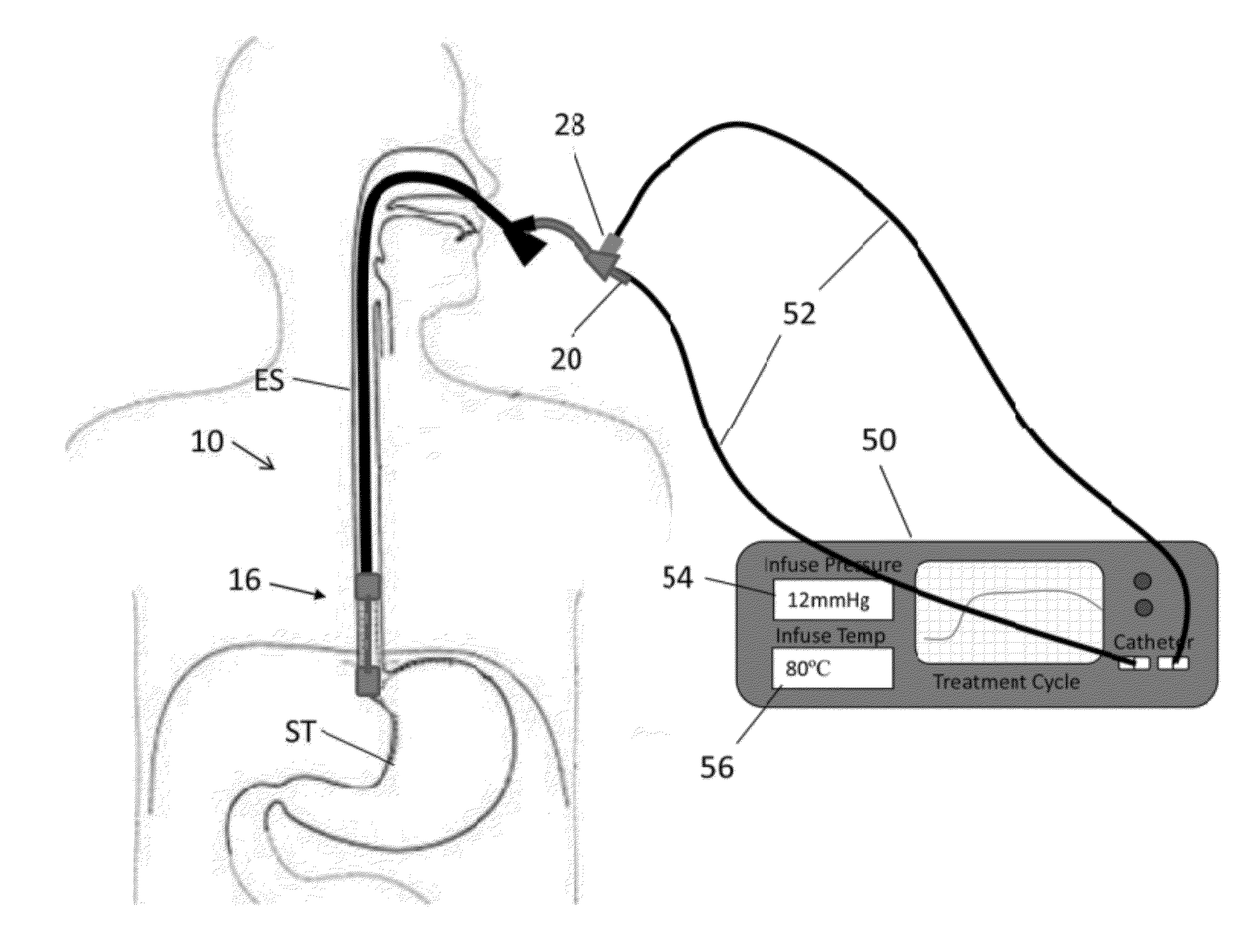 Methods and apparatus for treatment of a body cavity or lumen