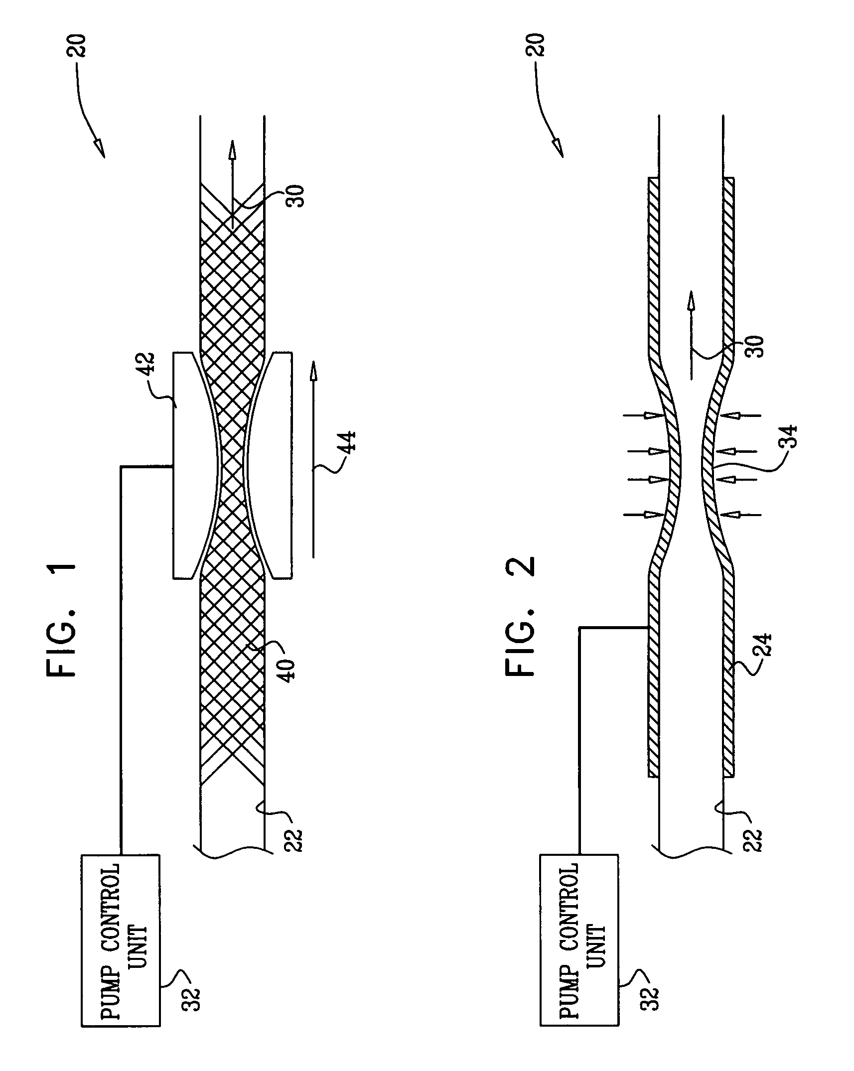 Implantable peristaltic pump to treat erectile dysfunction