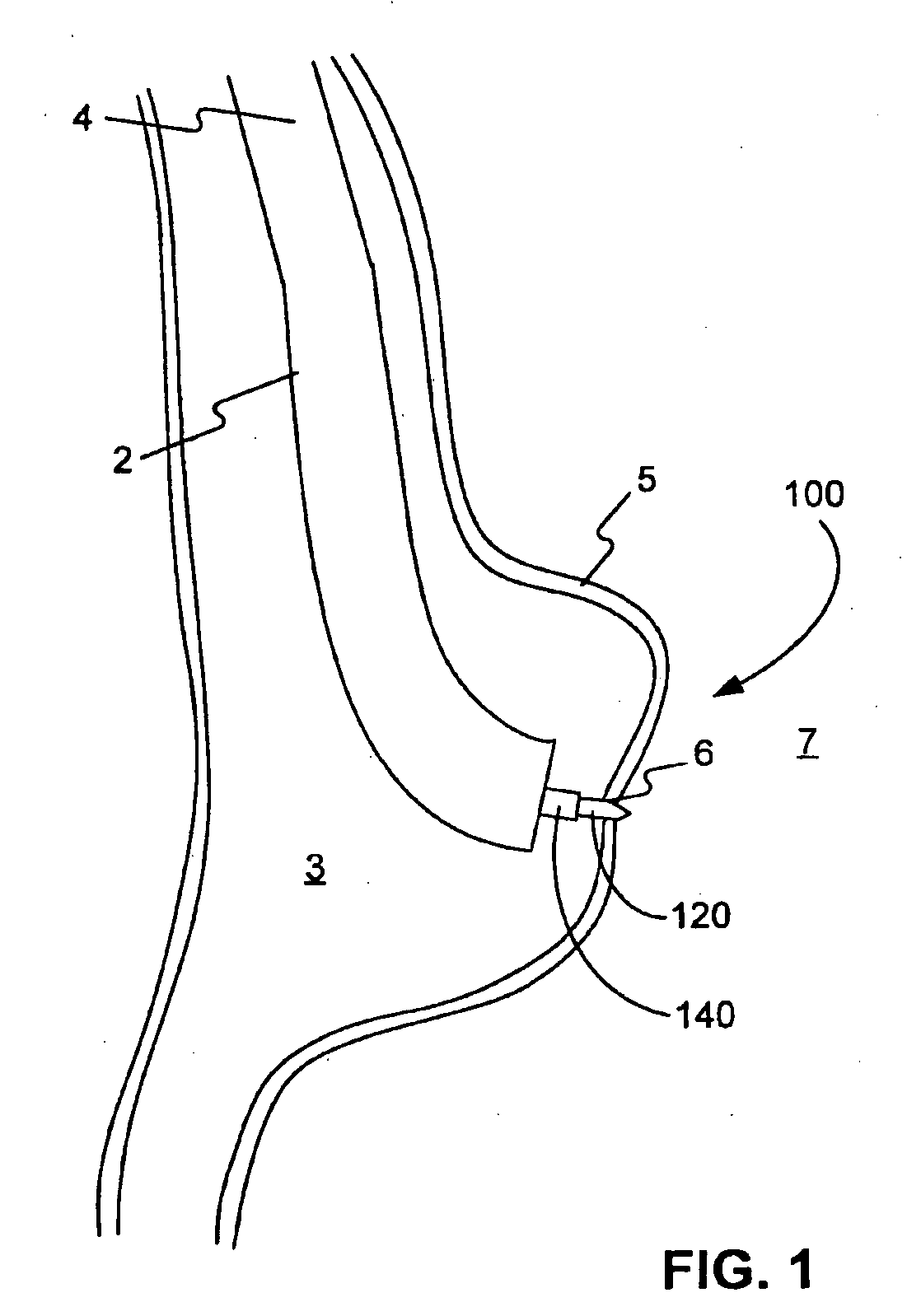 Tissue aperture securing and sealing apparatuses and related methods of use