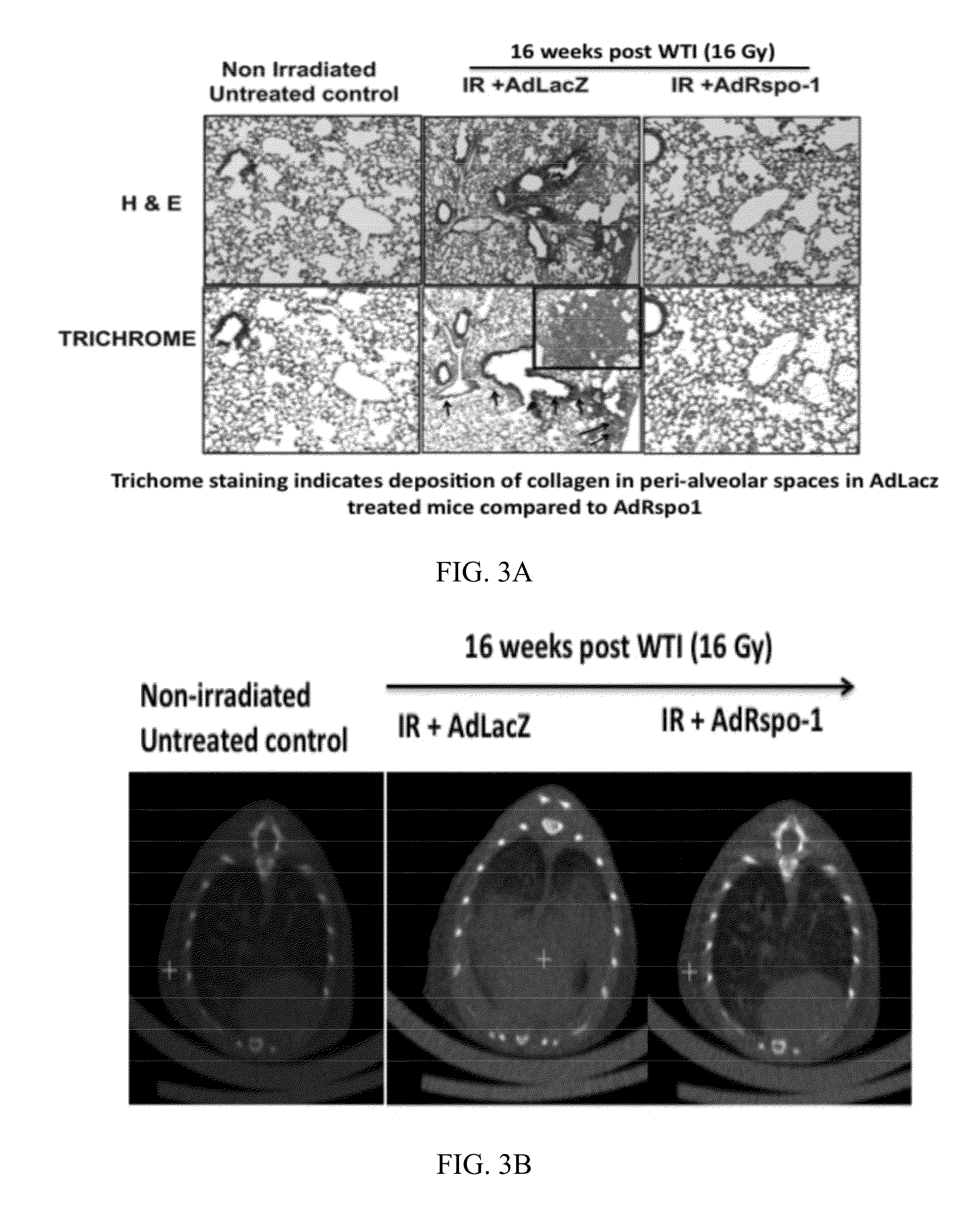 Therapy for radiation-induced lung injury