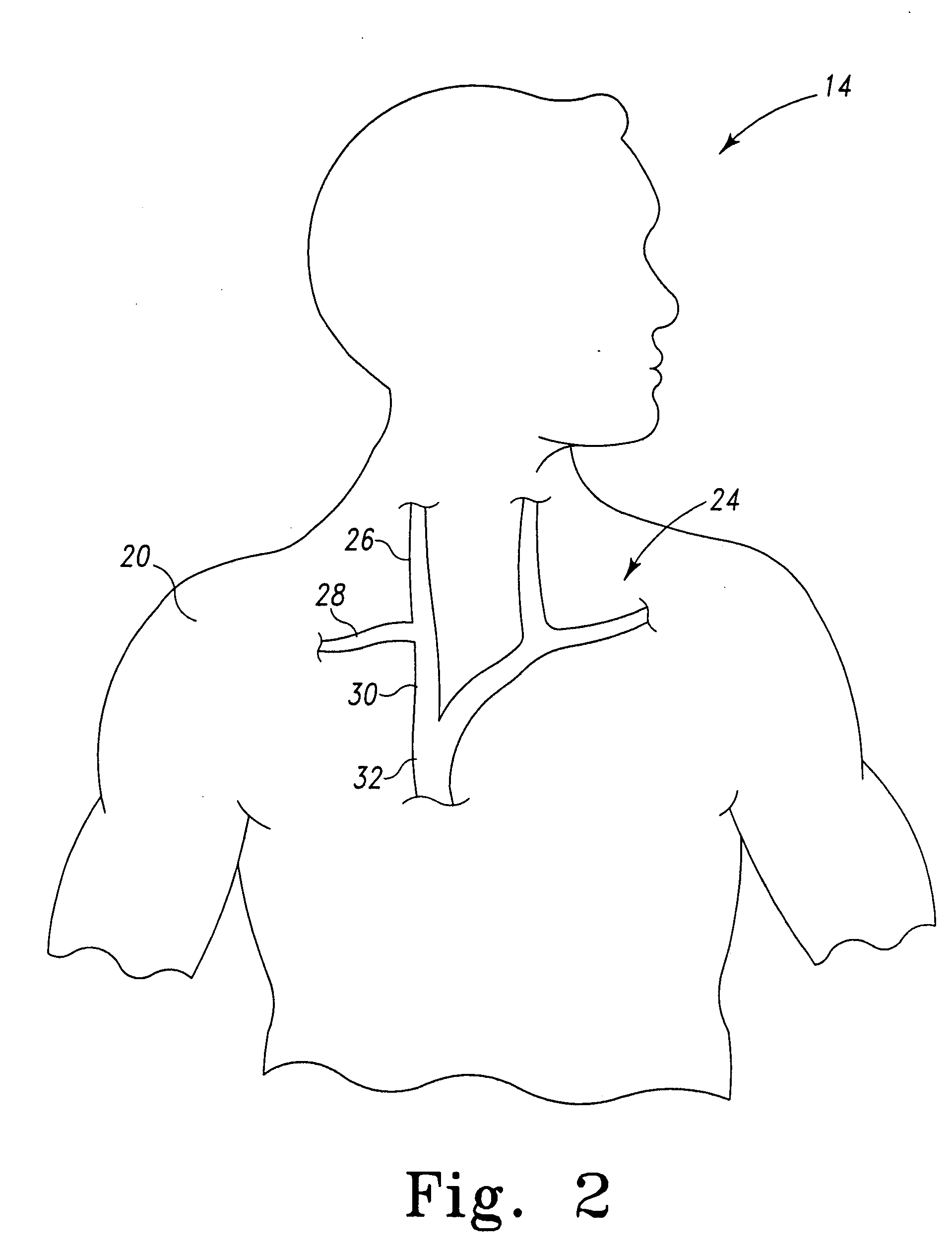 Methods of performing medical procedures with catheter systems having movable member