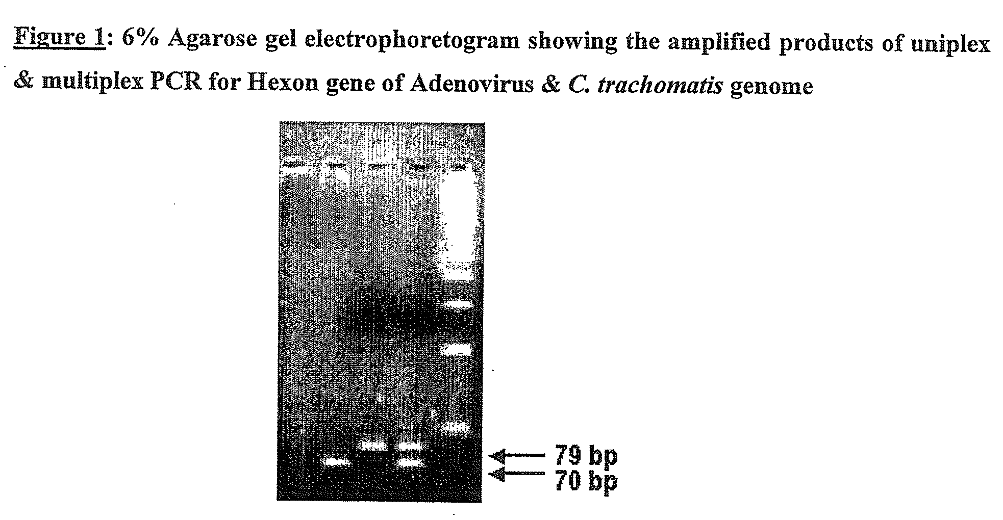 Novel method for simultaneous detection and discrimination of bacterial, fungal, parasitic and viral infections of eye and central nervous system