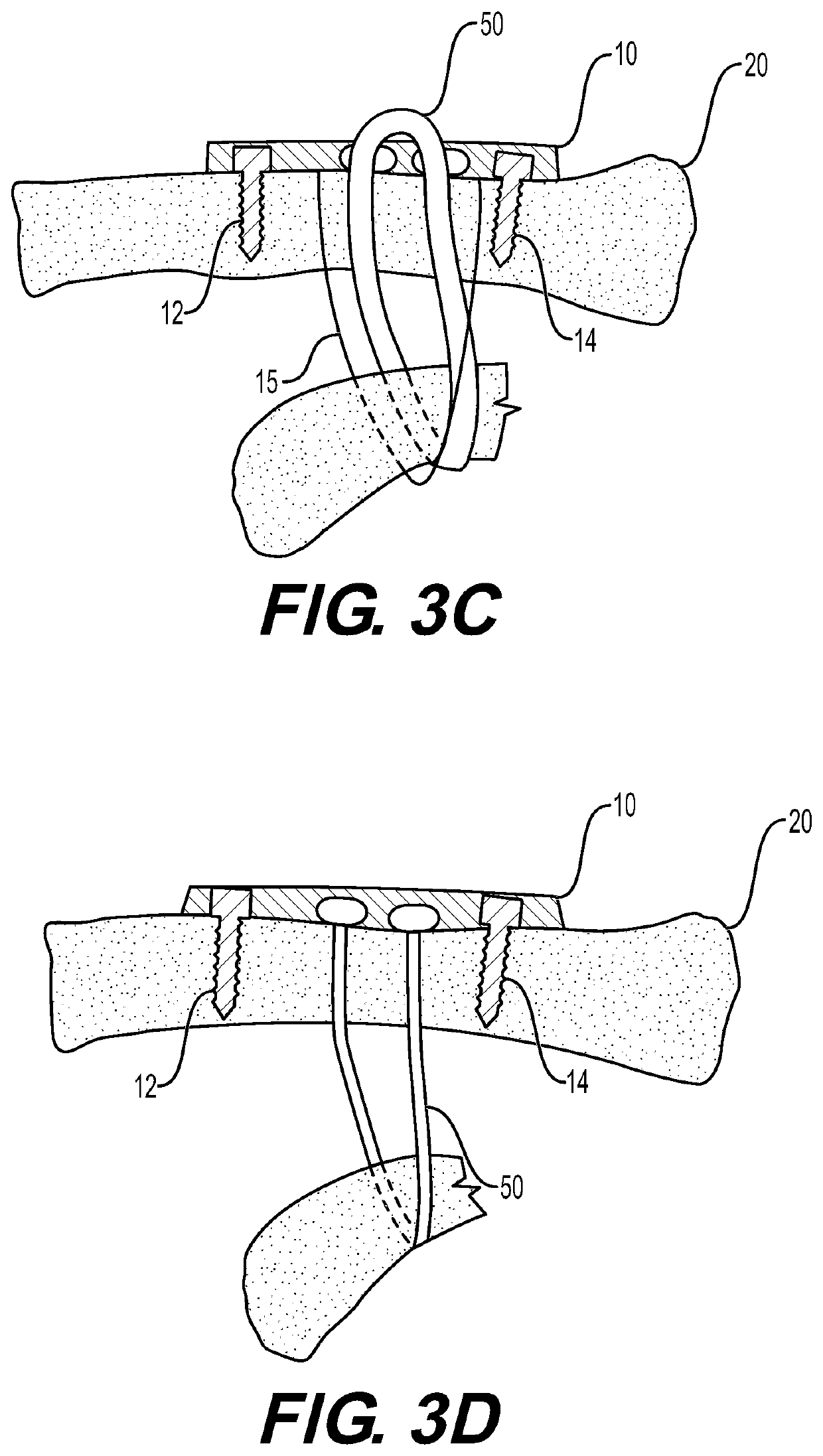 Device for and method of treating acromioclavicular joint dislocations