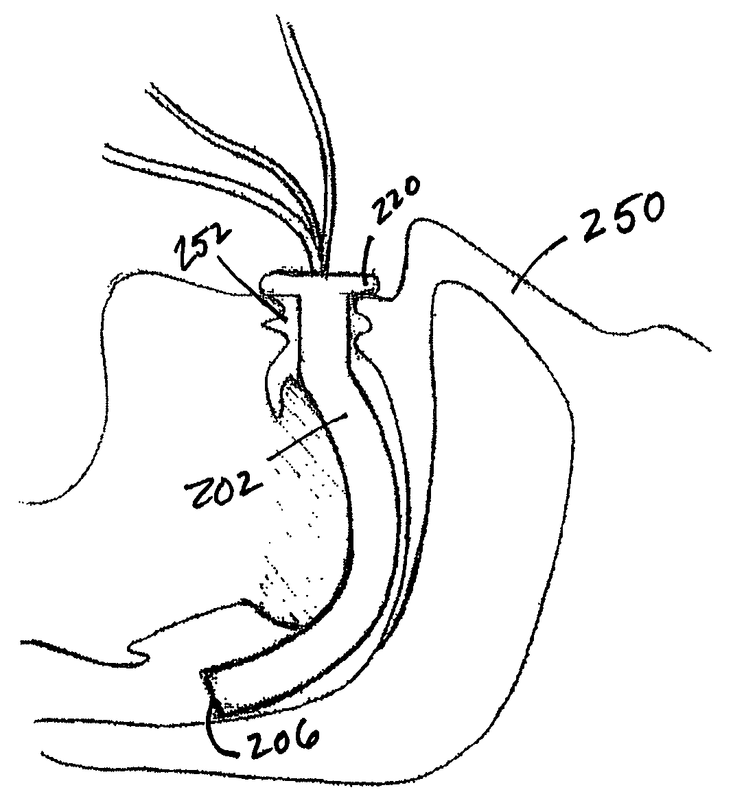 Oropharyngeal airway