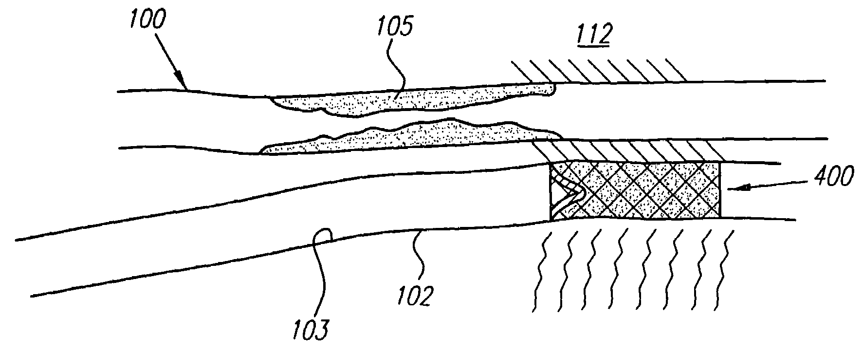 Systems and methods for delivering drugs to selected locations within the body