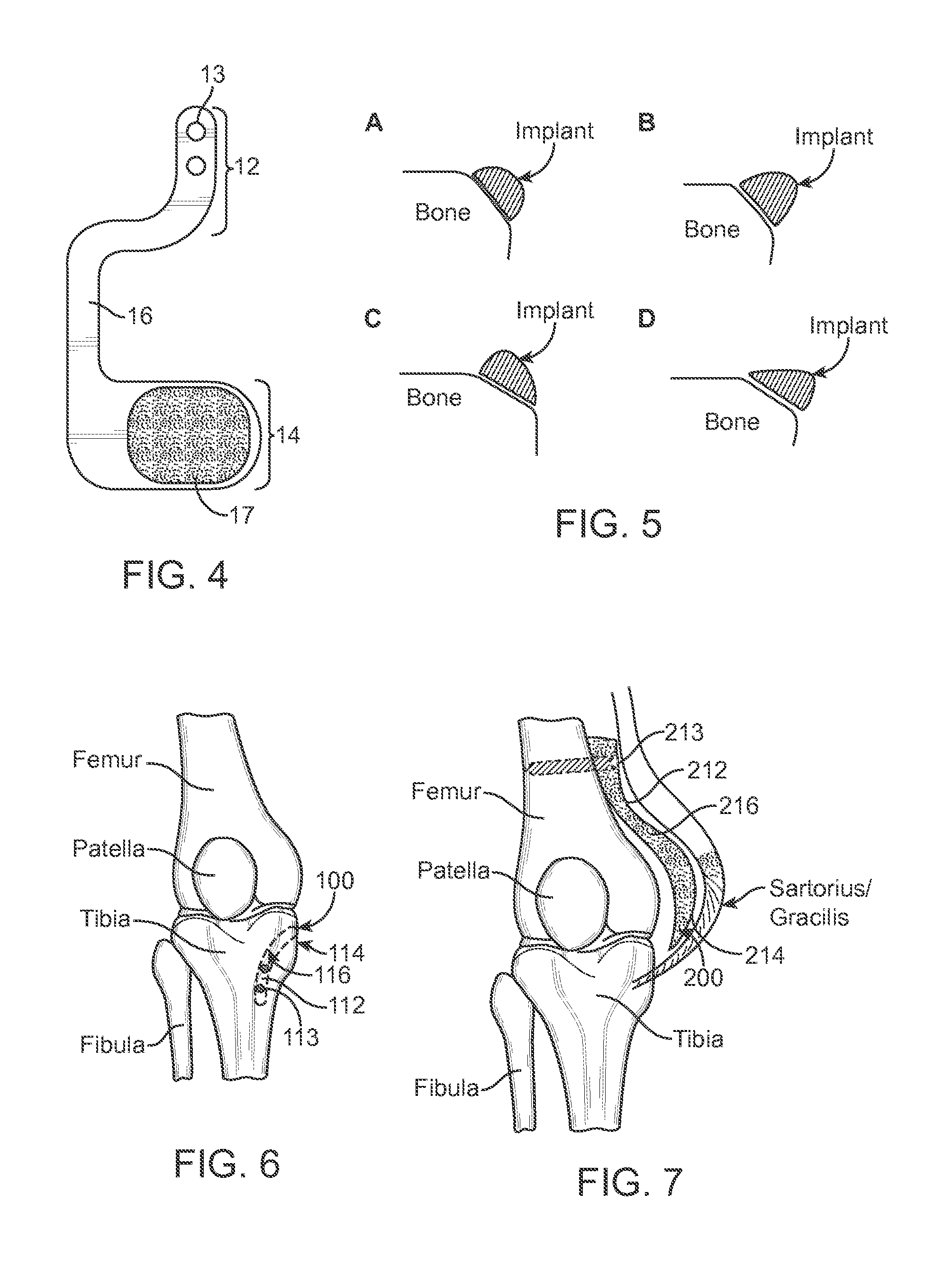 Method and Apparatus for Altering Biomechanics of the Articular Joints