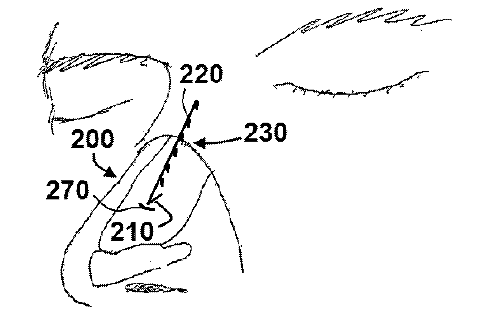 Apparatus and methods for correcting nasal valve collapse