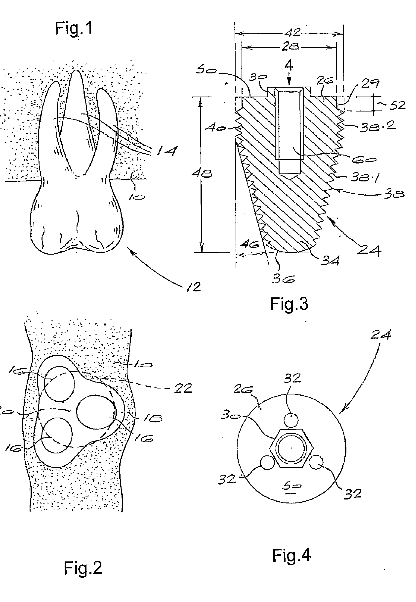 Molar Implant and Method