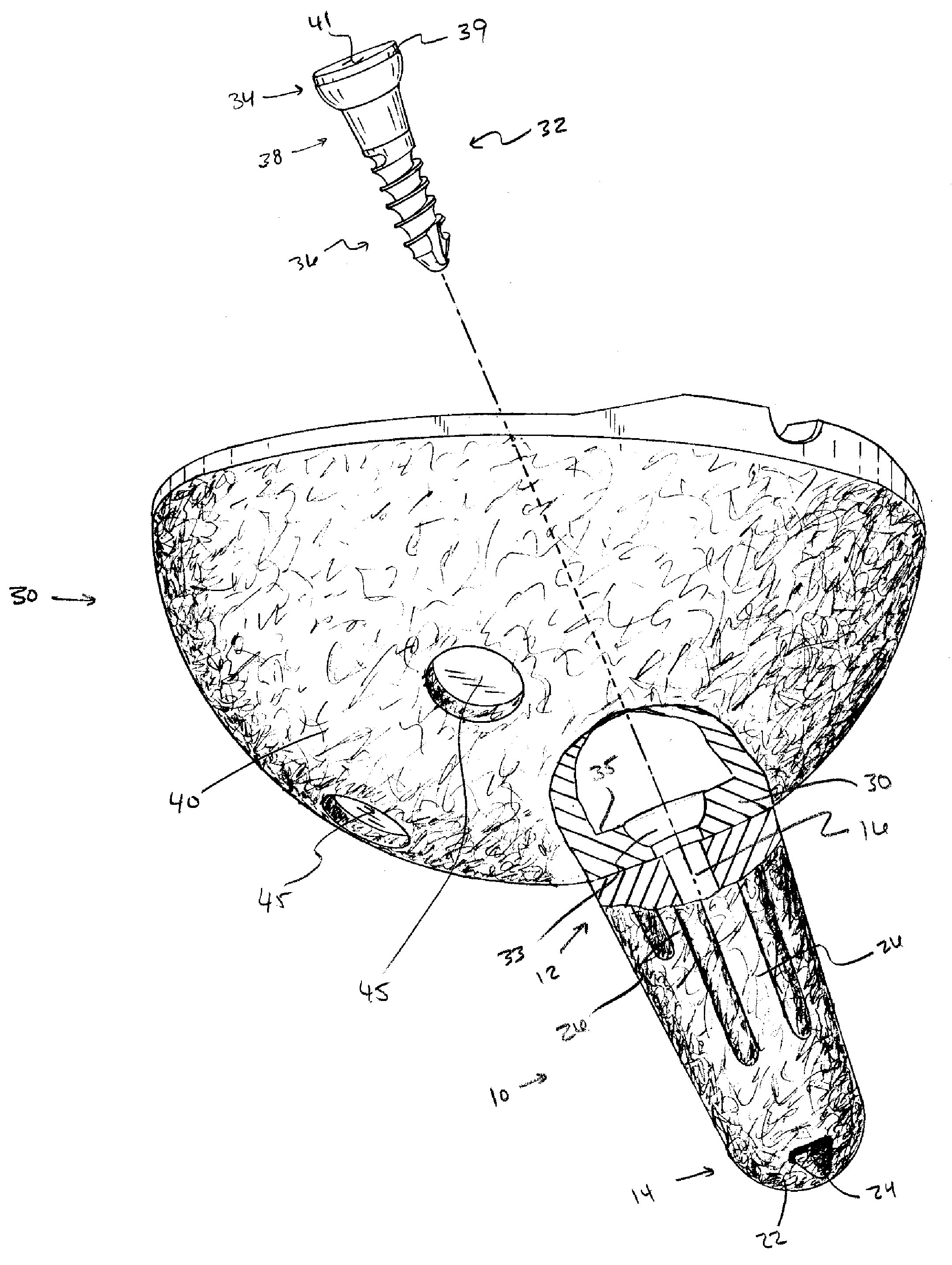Implant anchoring device