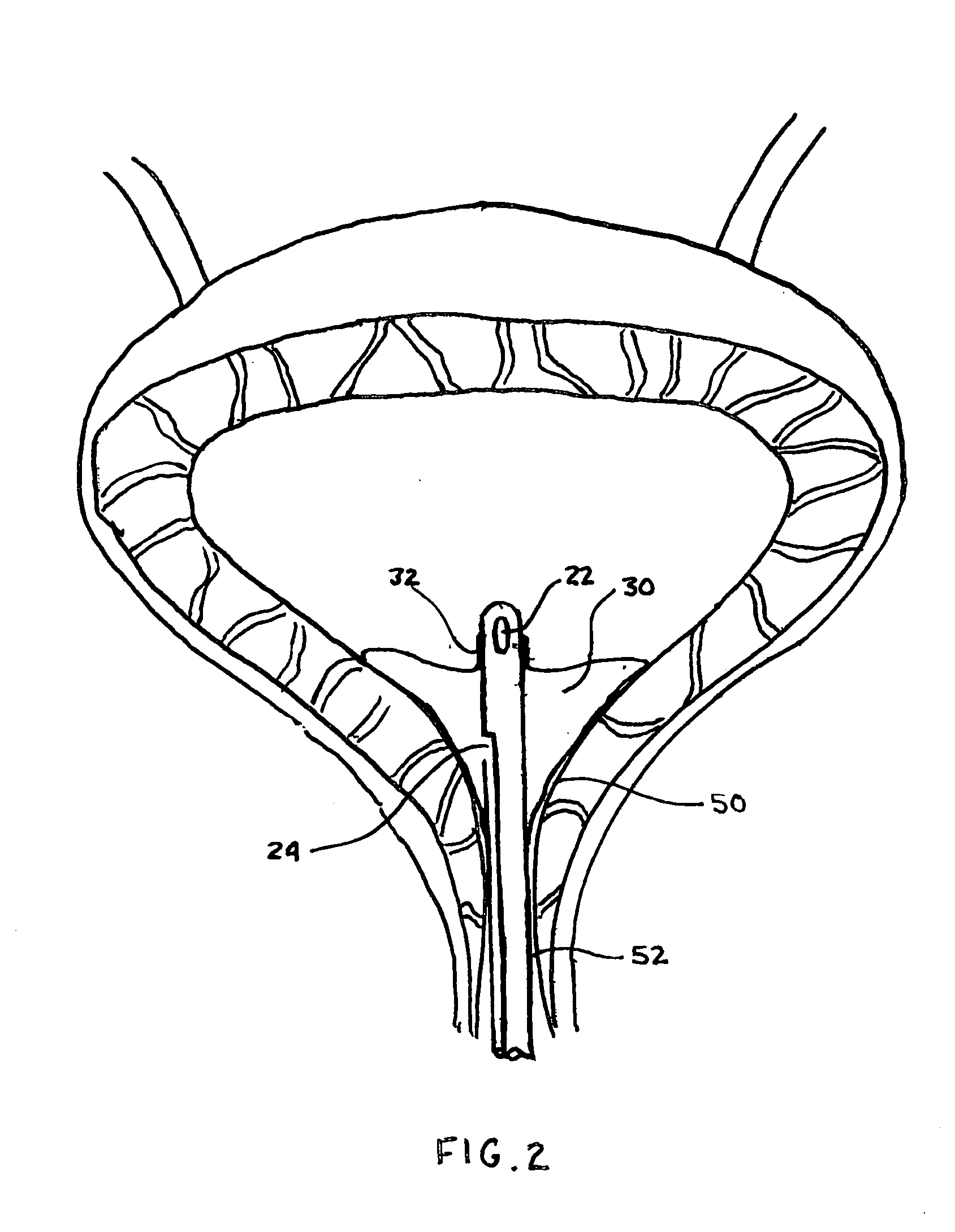 Indwelling urinary catheter with enlarged sealing surface