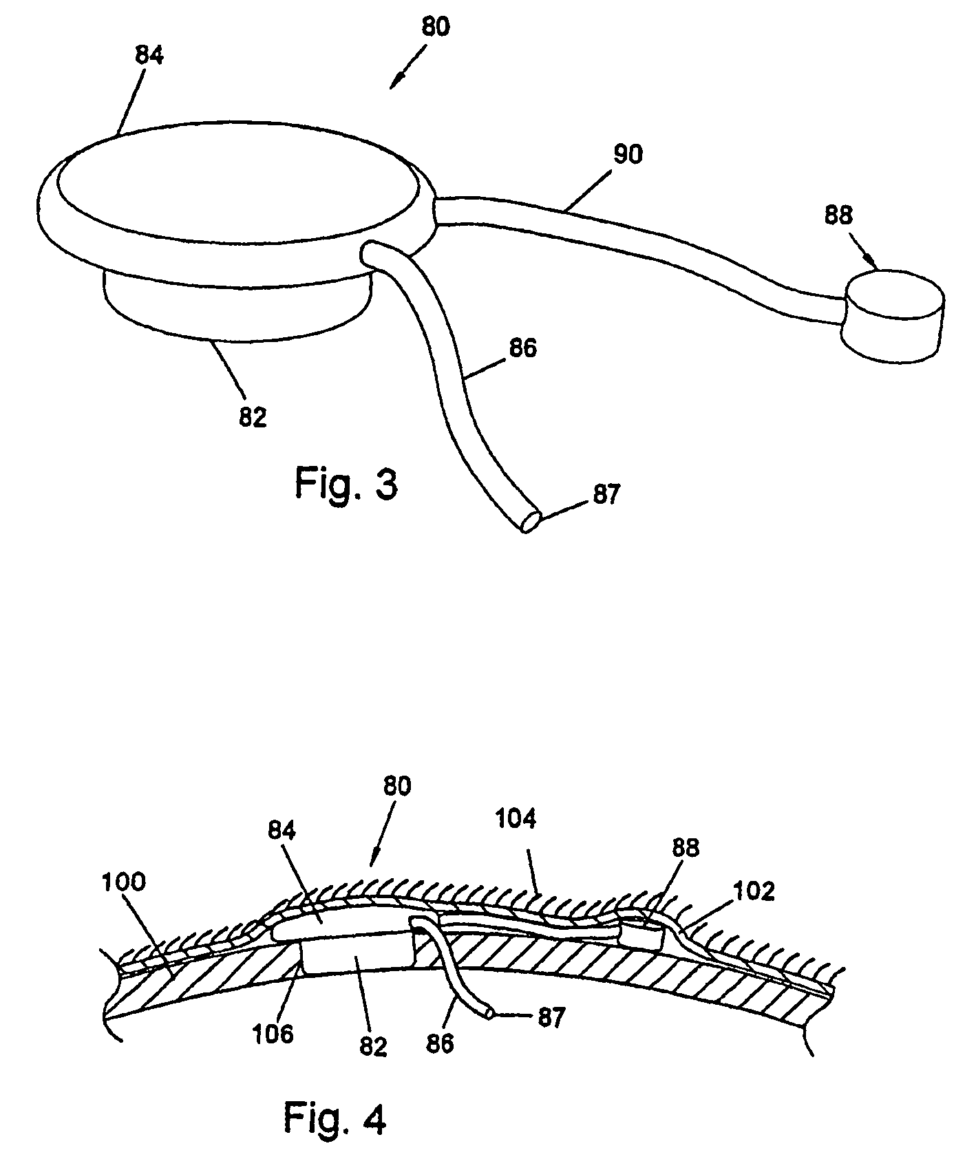 Implantable medication delivery device