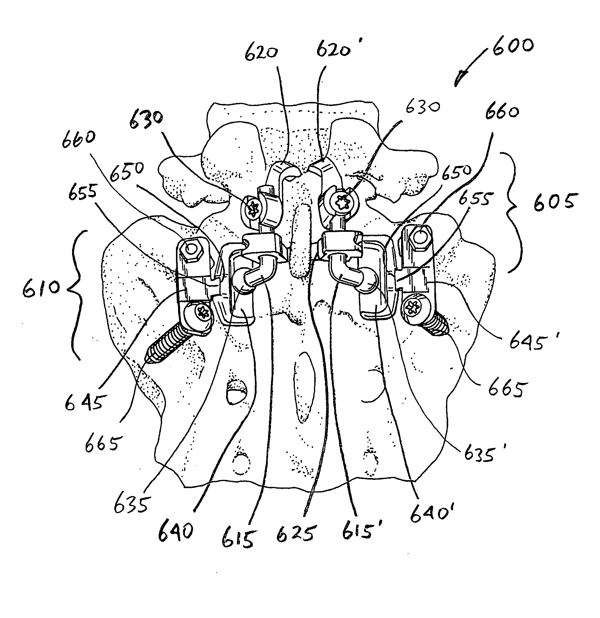 Facet and disc arthroplasty system and method