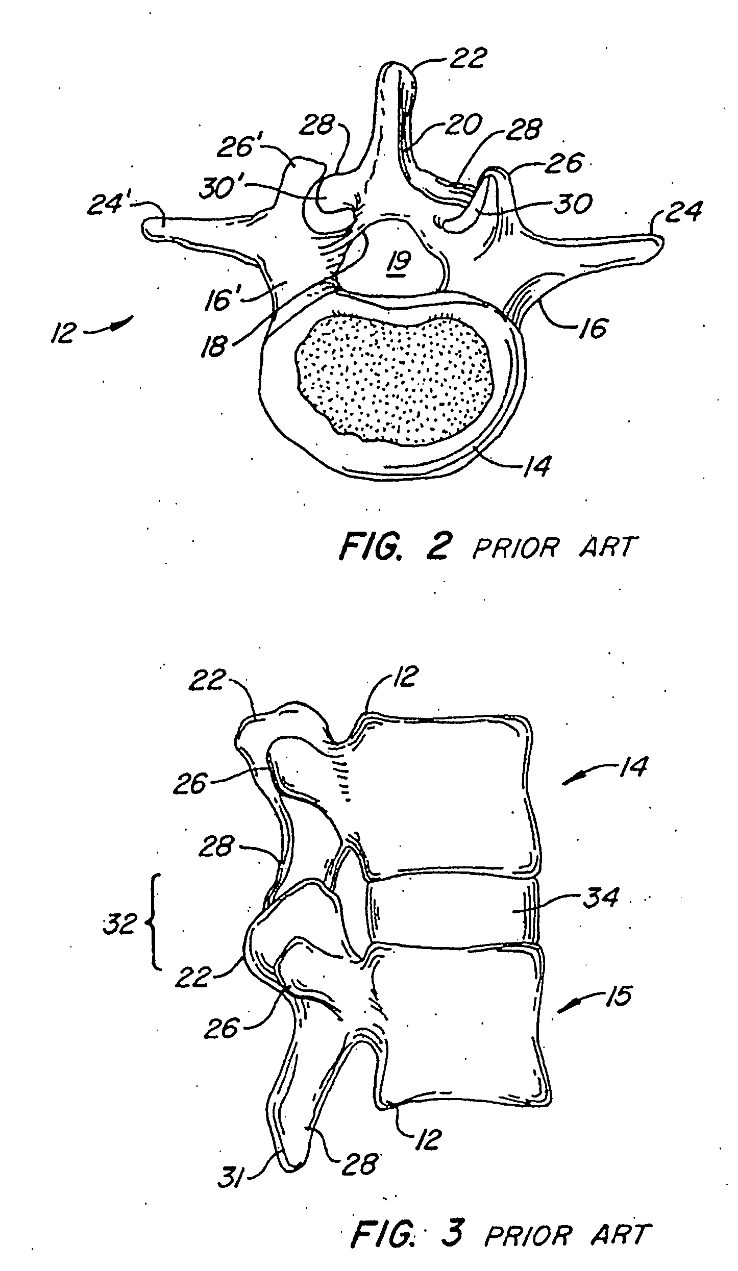 Facet and disc arthroplasty system and method