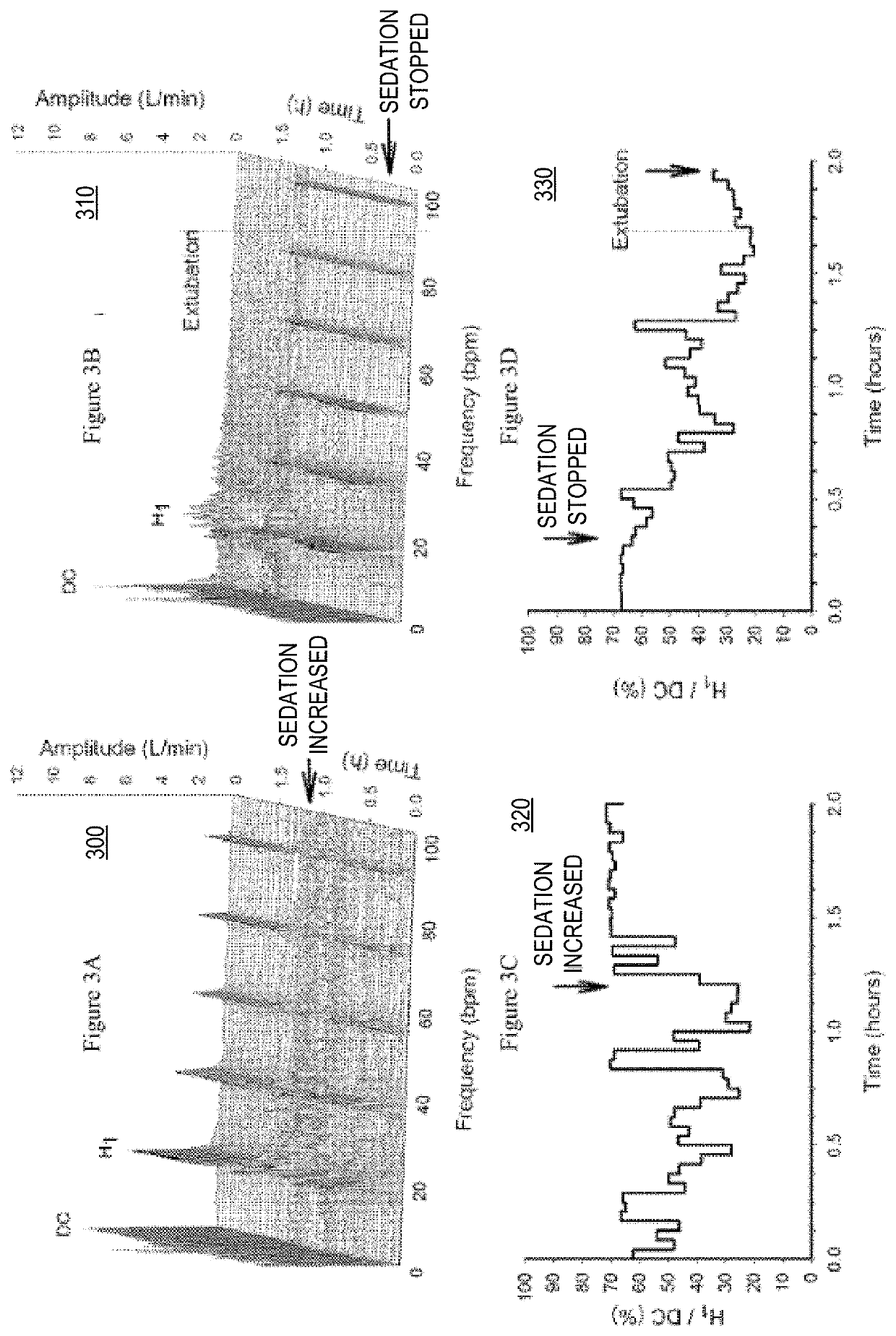 Detection and Display of Respiratory Rate Variability, Mechanical Ventilation Machine Learning, and Double Booking of Clinic Slots, System, Method, and Computer Program Product