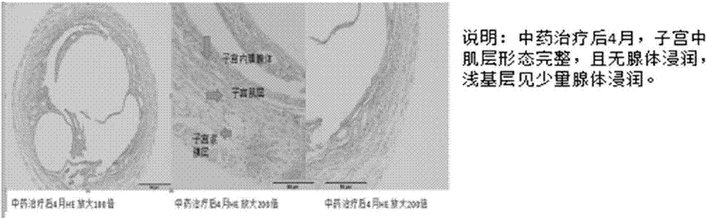 Chinese herbal medicine capsule preparation for treating adenomyosis and preparation method thereof