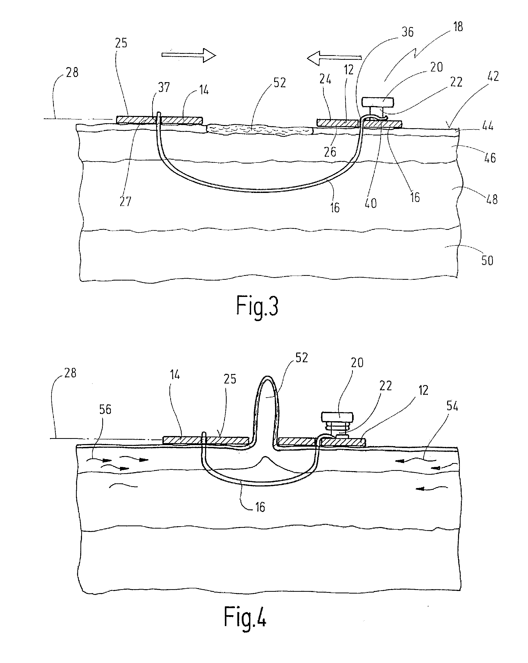 Device For Stretching Regions Of Tissue