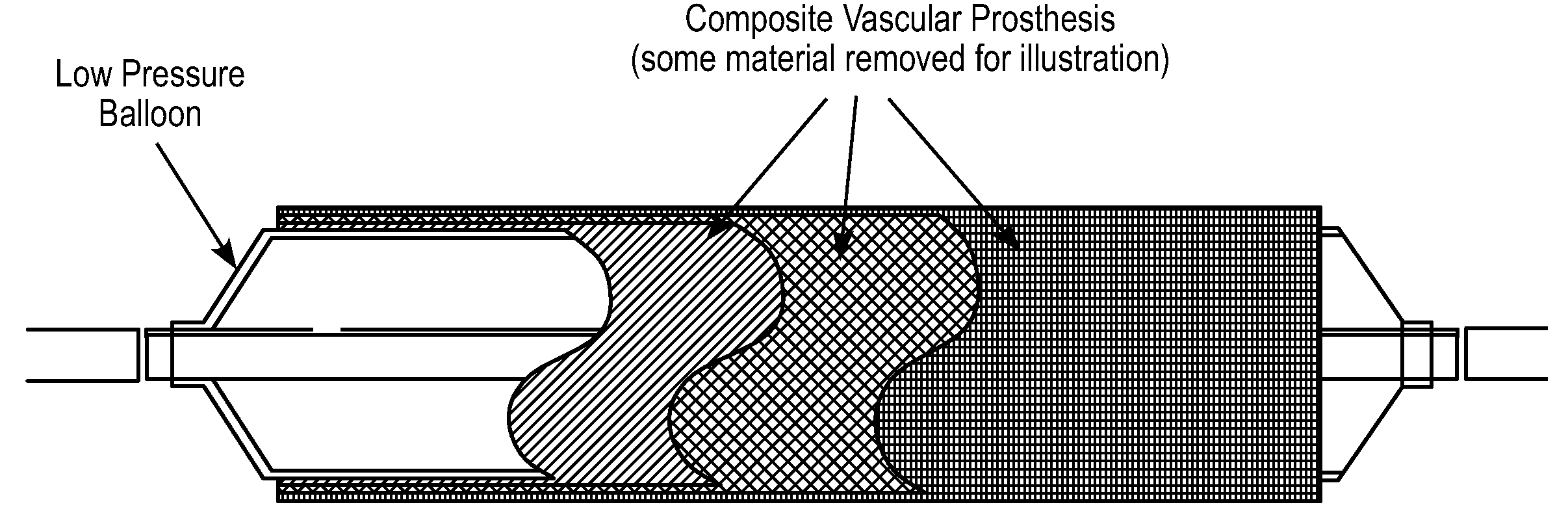 Composite Vascular Prosthesis