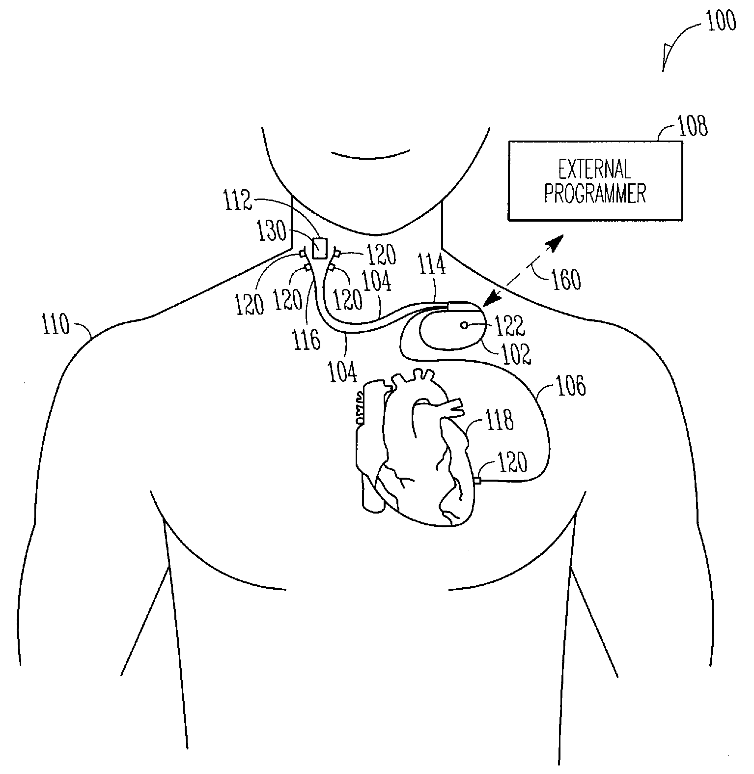 Selective nerve stimulation with optionally closed-loop capabilities