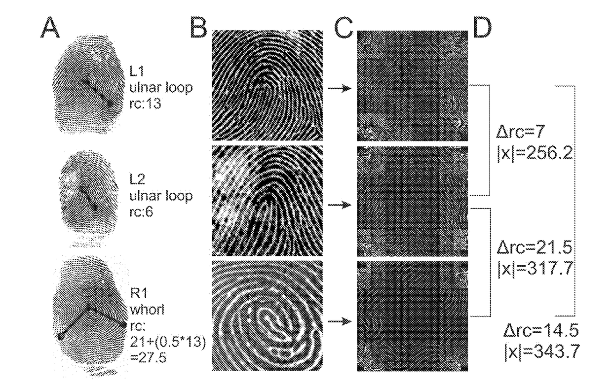 detection-systems-using-fingerprint-images-for-type-1-diabetes-mellitus