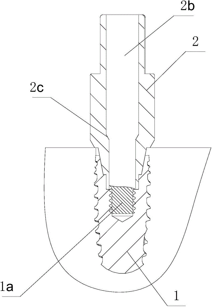 Implant removal tool and removal method