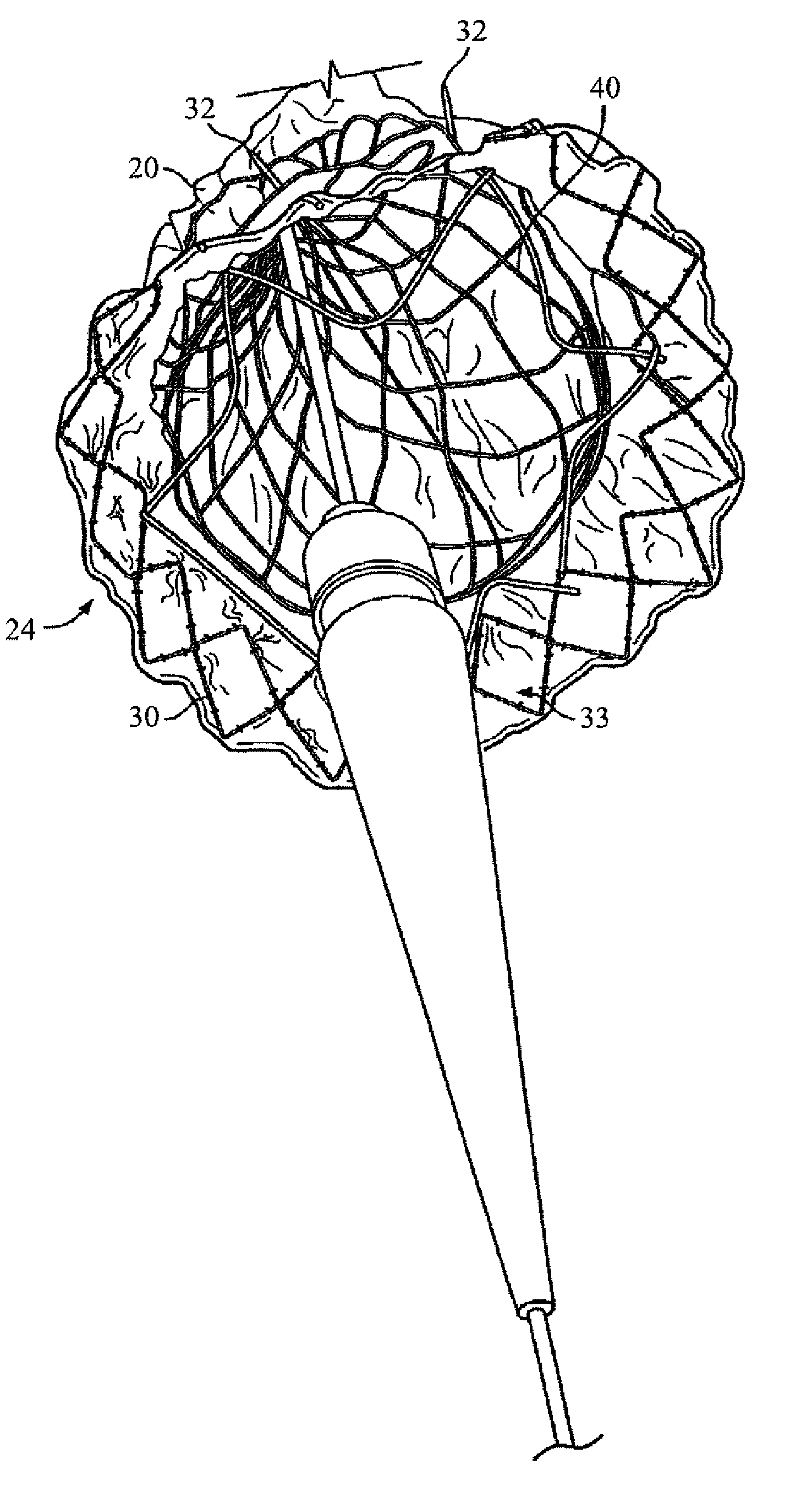 Method for Deployment of a Stent Graft