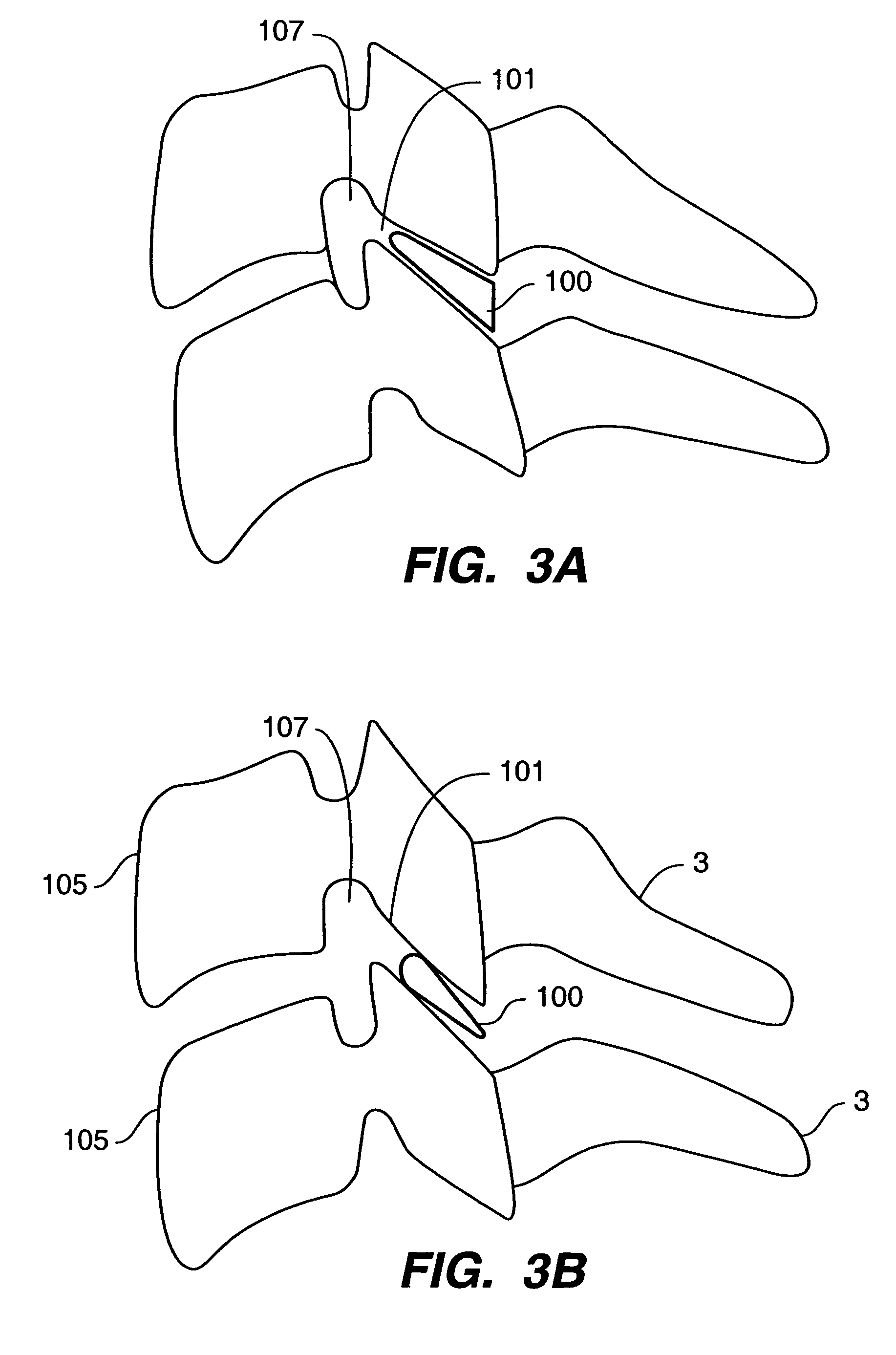 Inter-cervical facet implant and method for preserving the tissues surrounding the facet joint