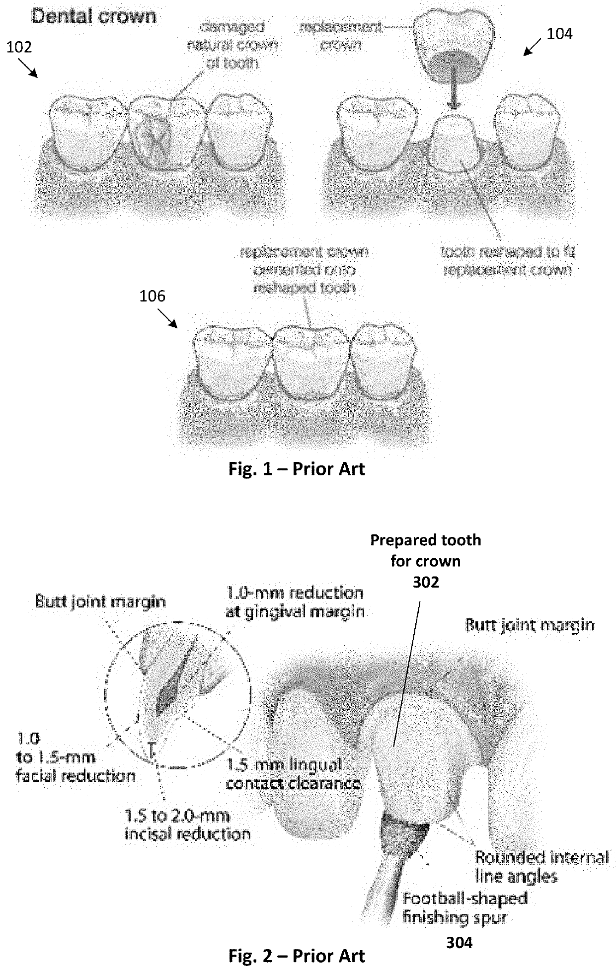 Interproximal polishing bur