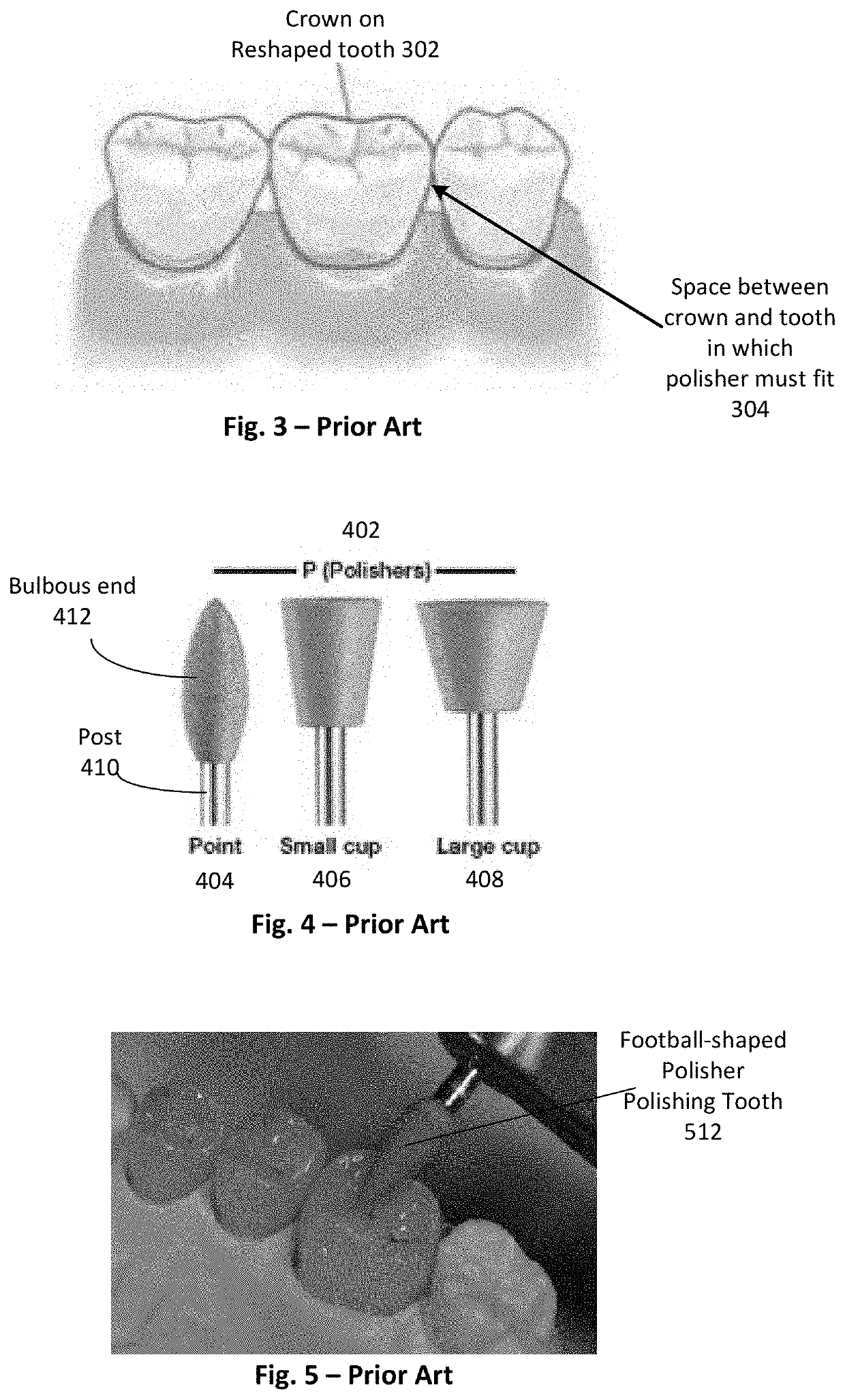 Interproximal polishing bur