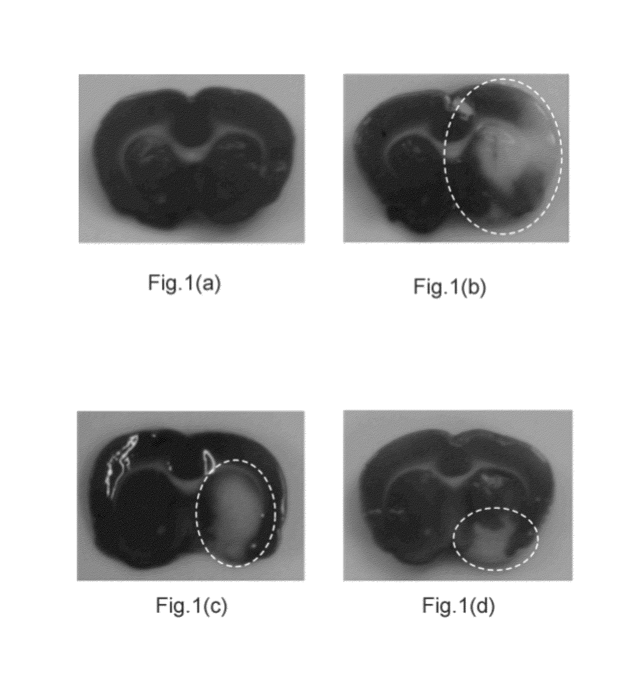 Drug Delivery Method Via Brain Extracellular Space and a Device Thereof