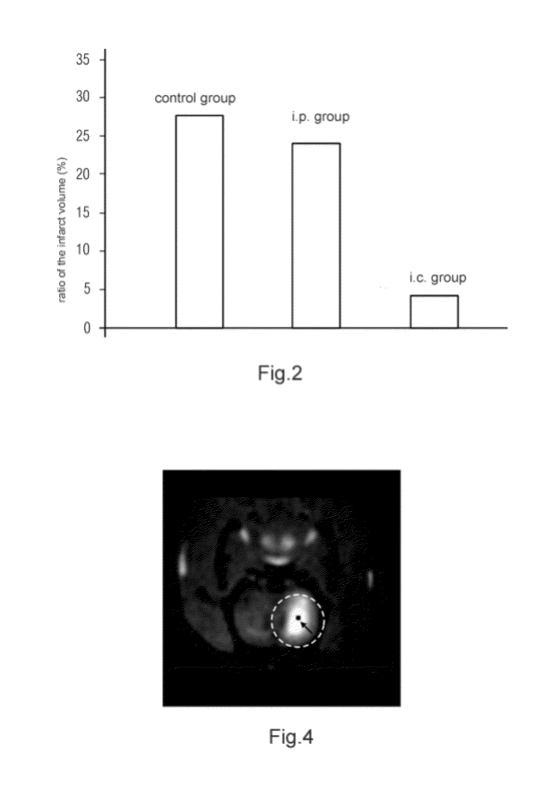Drug Delivery Method Via Brain Extracellular Space and a Device Thereof