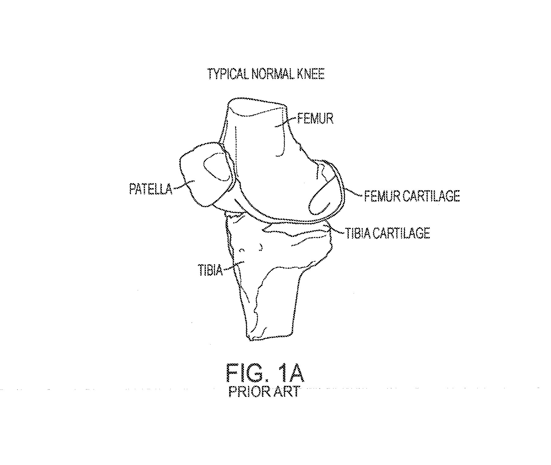 Implant for Restoring Normal Range Flexion and Kinematics of the Knee