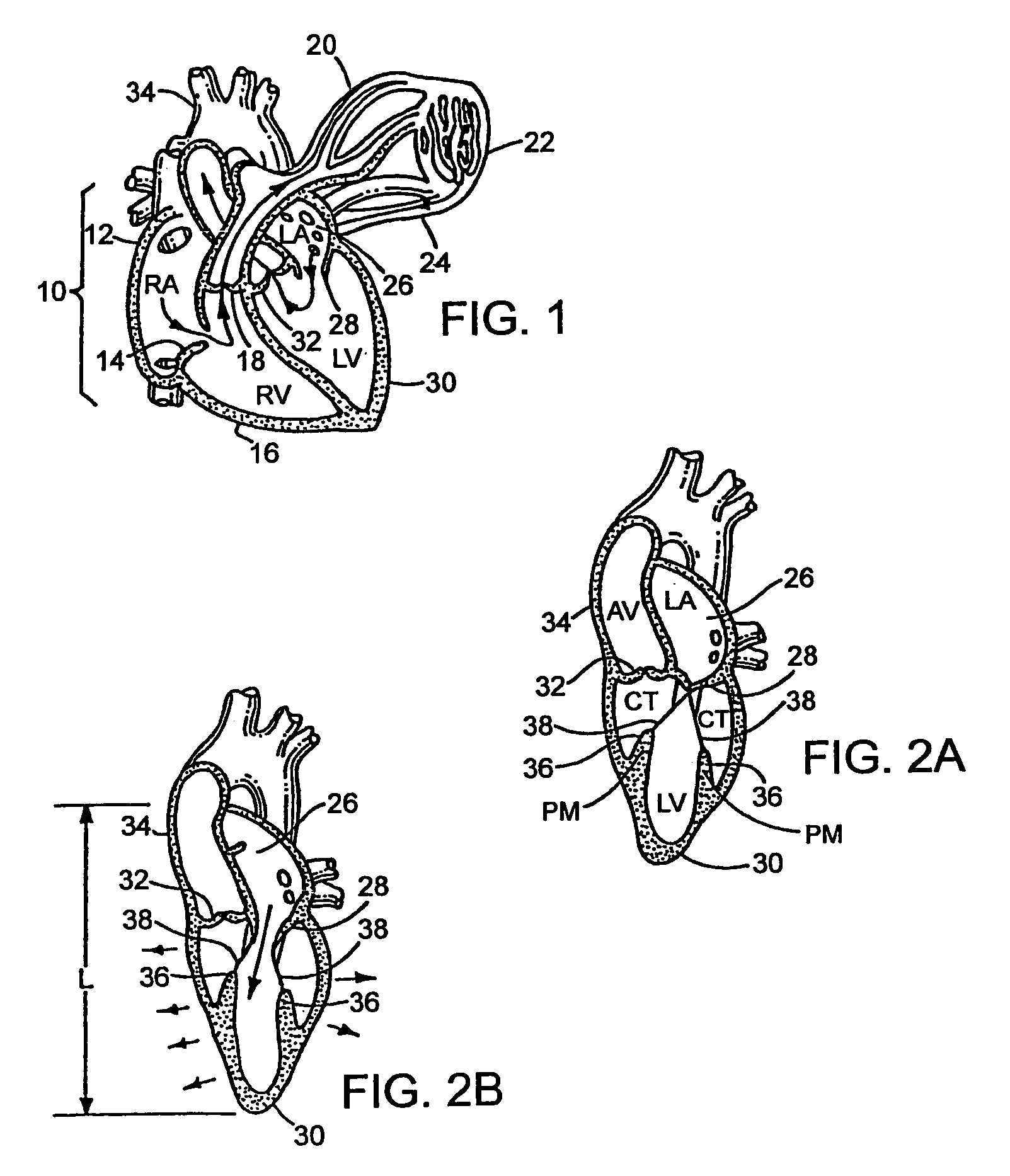 Device to permit offpump beating heart coronary bypass surgery