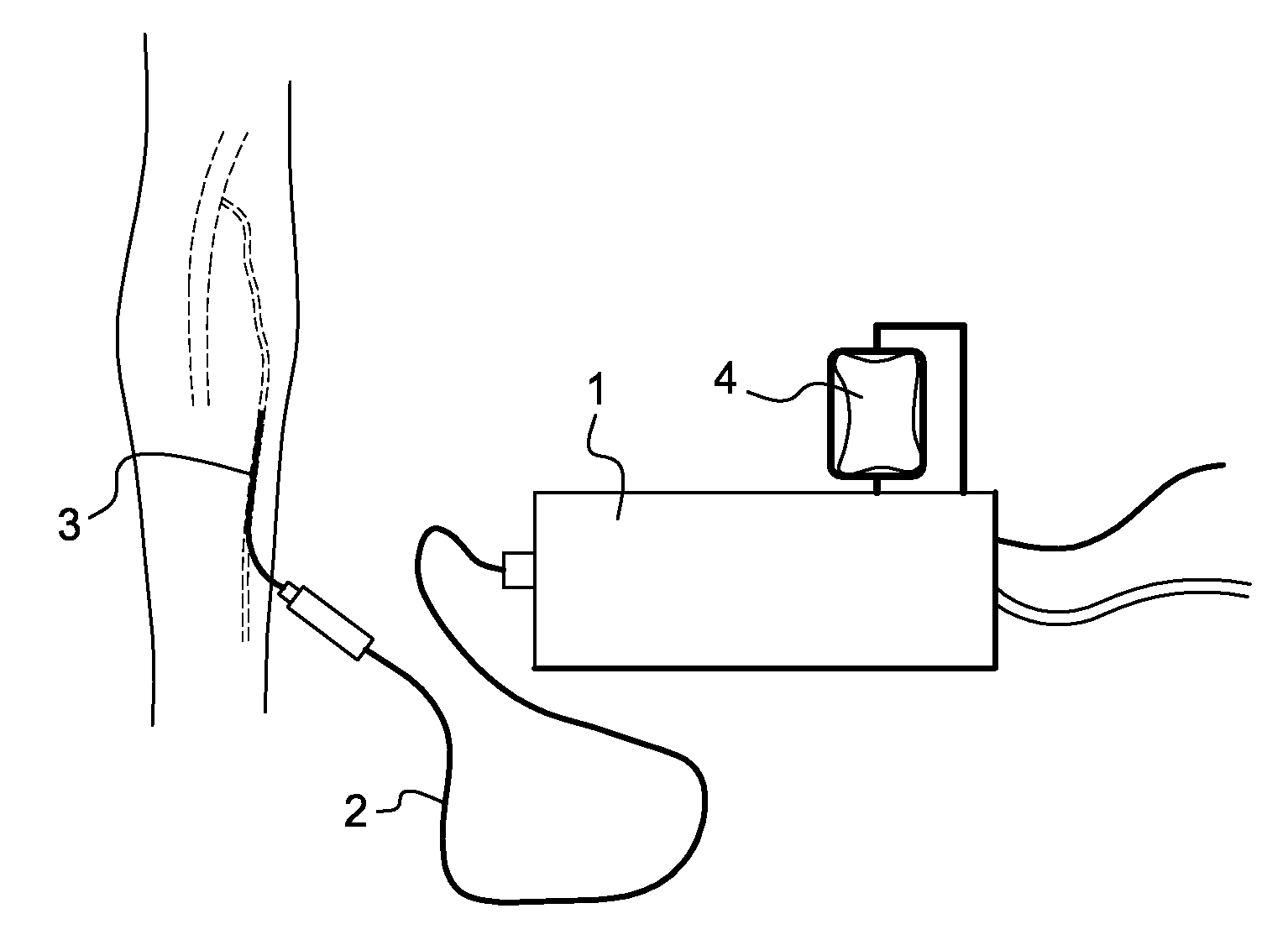 Apparatus for injecting steam into a human or animal blood vessel
