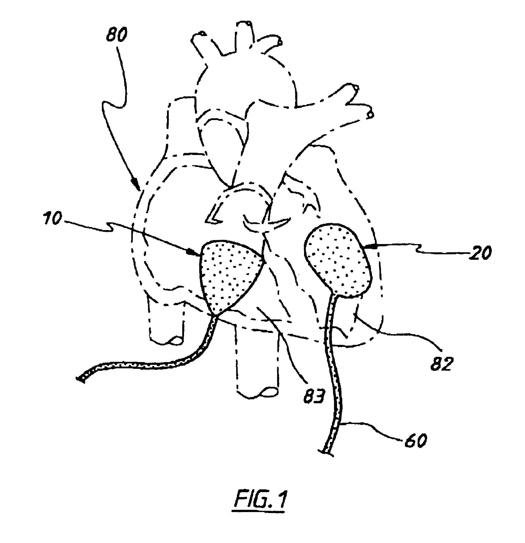 Assist device for the failing heart