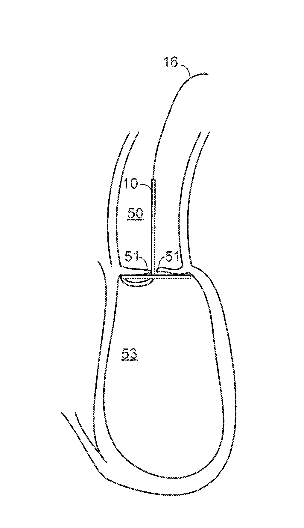 TAVR Ventricular Catheter