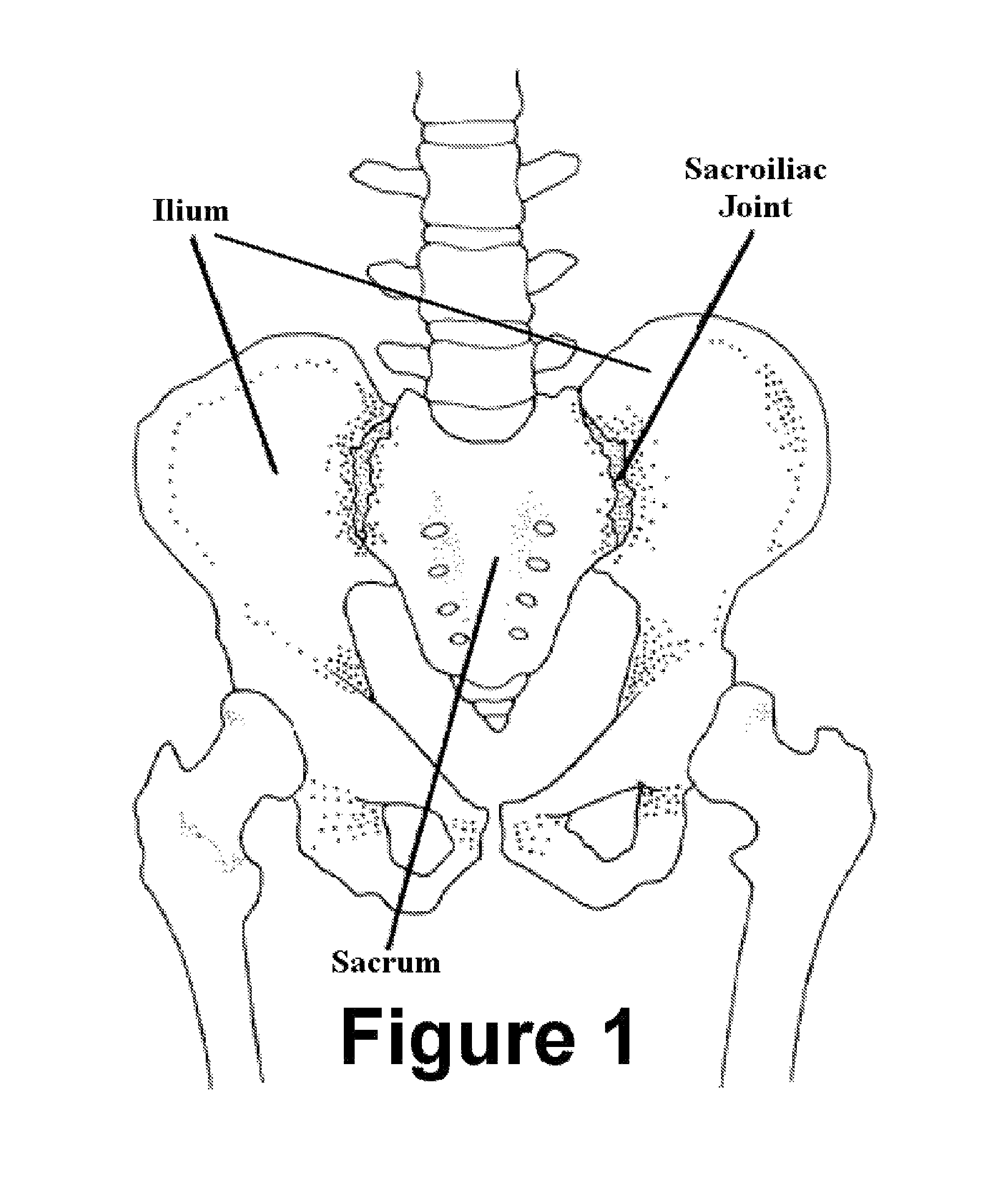 Method and apparatus for minimally invasive treatment of unstable pelvic ring injuries combined with hip arthroplasty