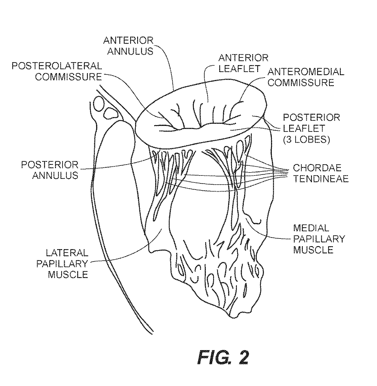 Expandable frames and paravalvular leak mitigation systems for implantable prosthetic heart valve devices