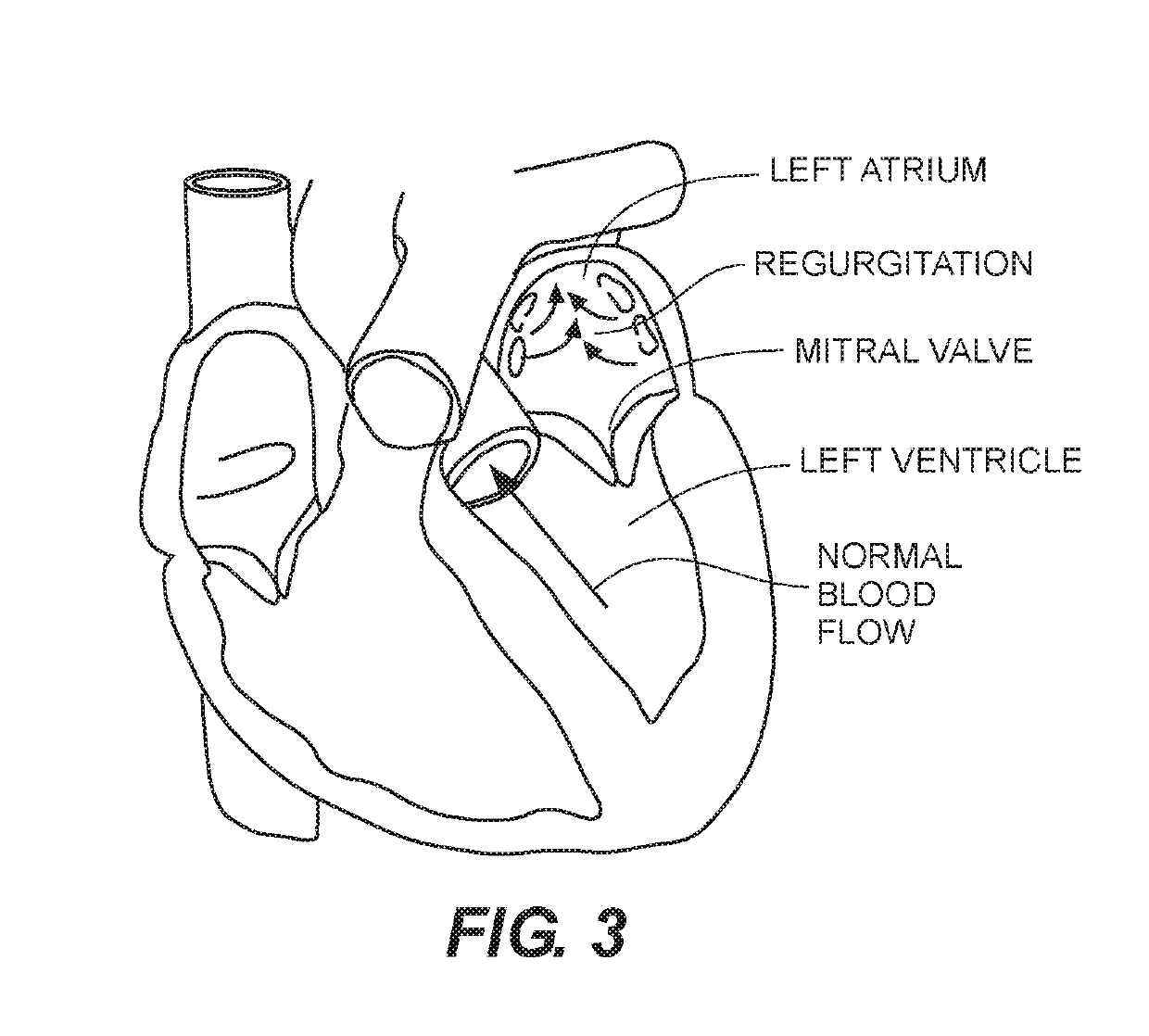 Expandable frames and paravalvular leak mitigation systems for implantable prosthetic heart valve devices