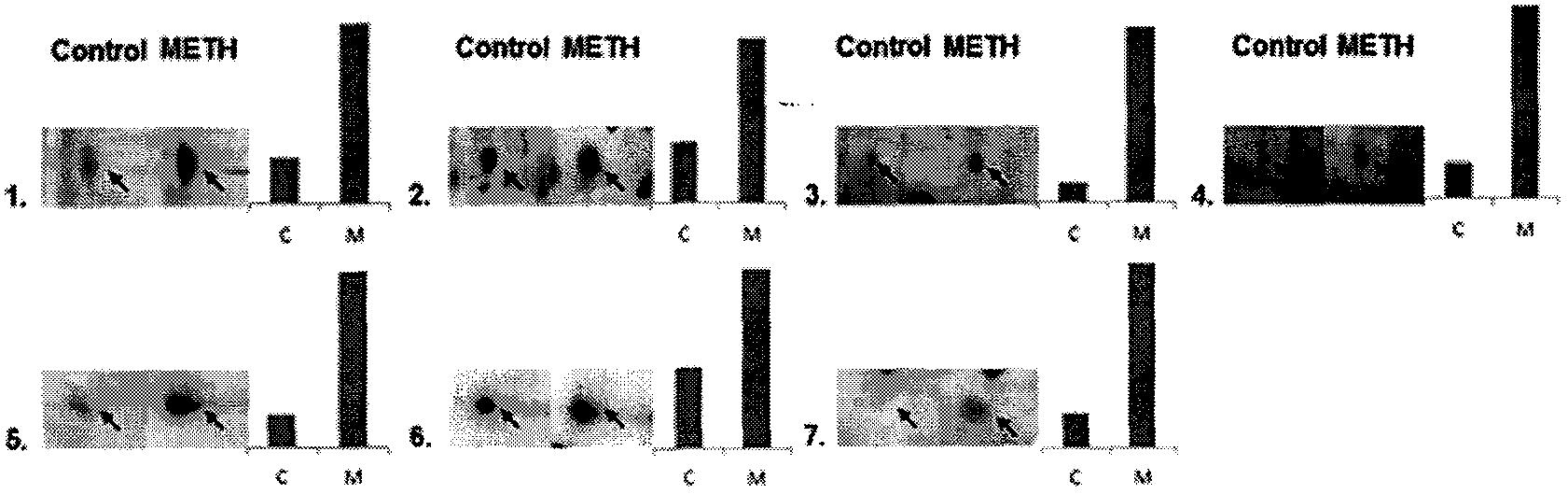 Application of complement factor H (CFH) to genetic expression products of methamphetamine (METH) addiction patient