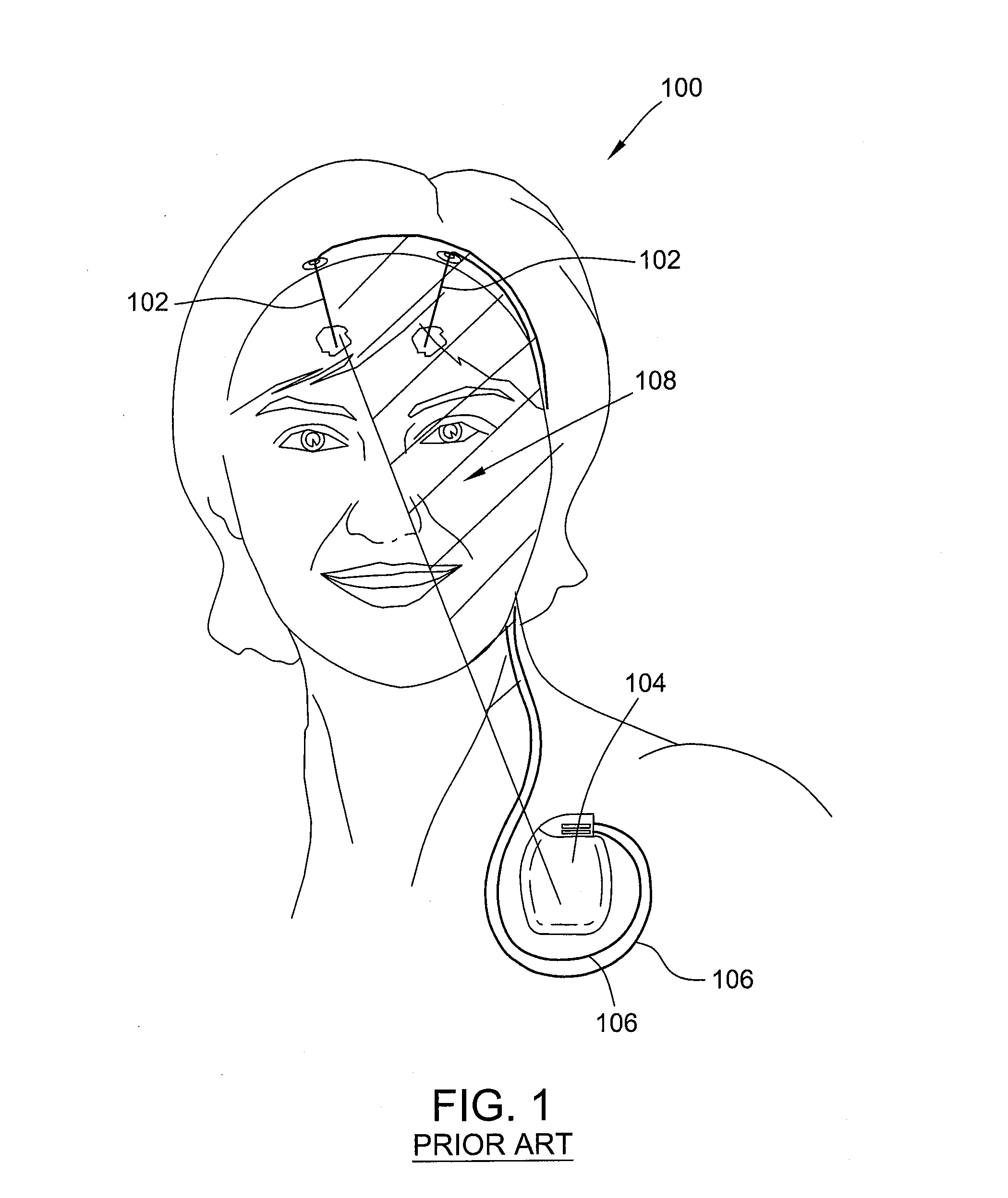 Implantable neurostimulation systems and methods thereof