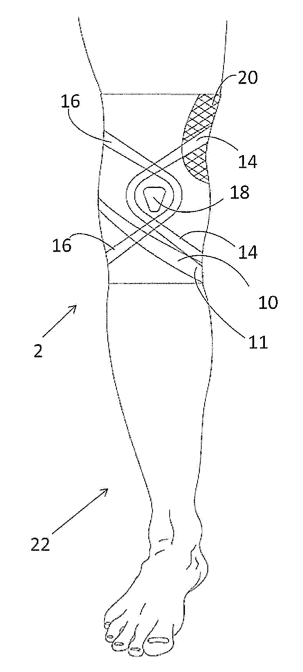Garment for Promoting Dynamic Alignment of a Knee