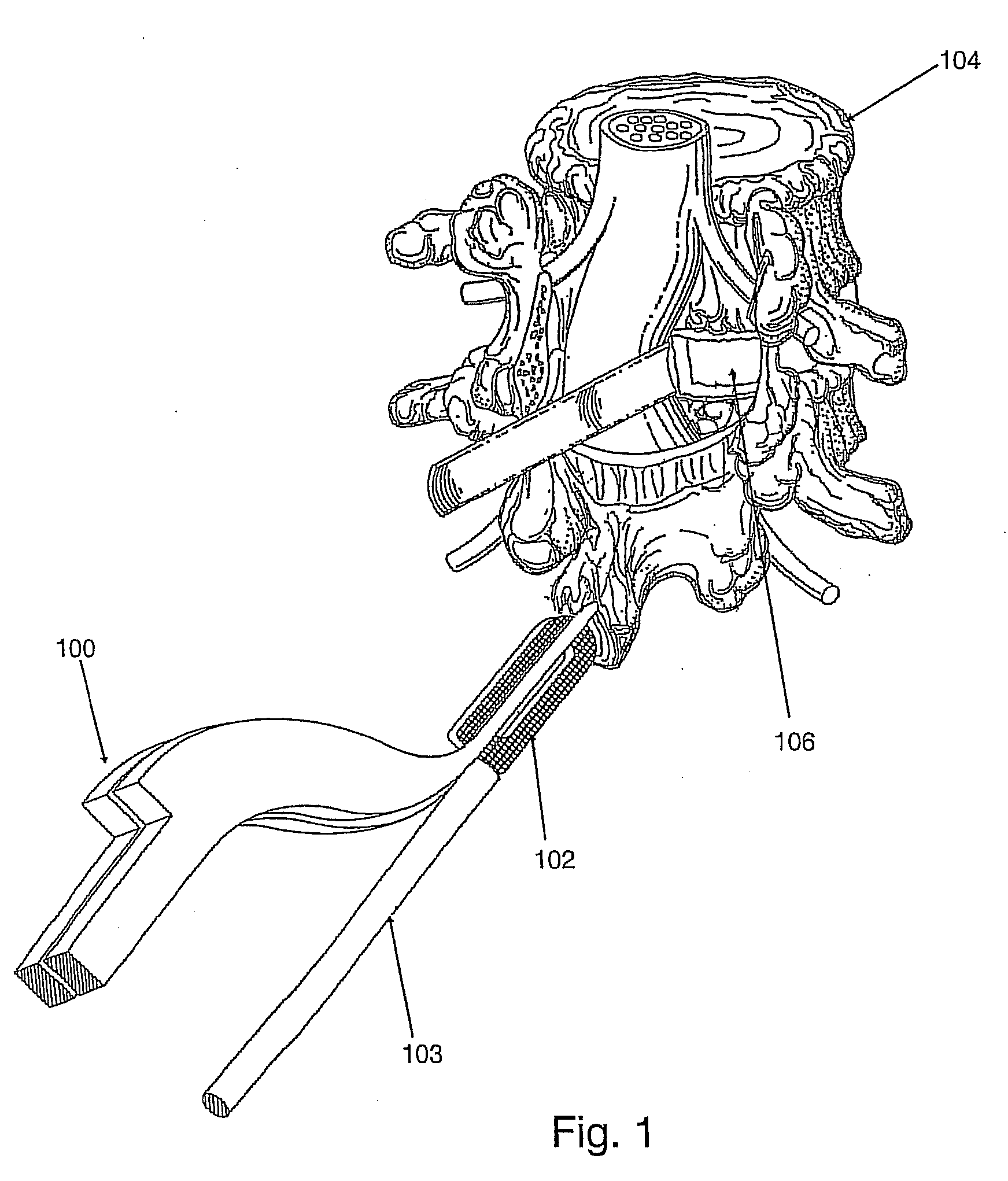 Spinal implant apparatus, method and system