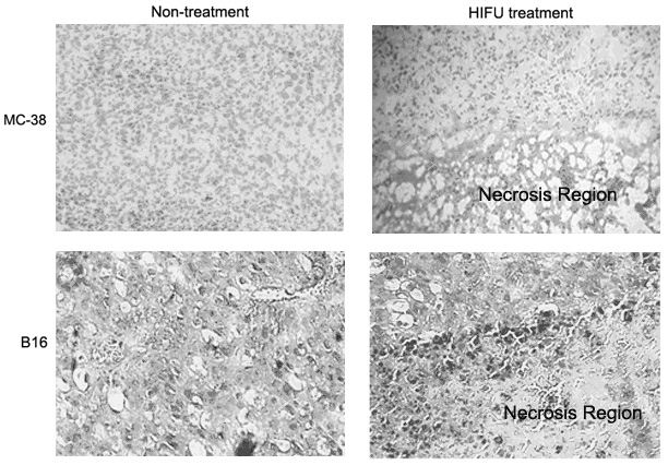 Method for enhancing high intensity focused ultrasound (HIFU) induced anti-tumor immune response