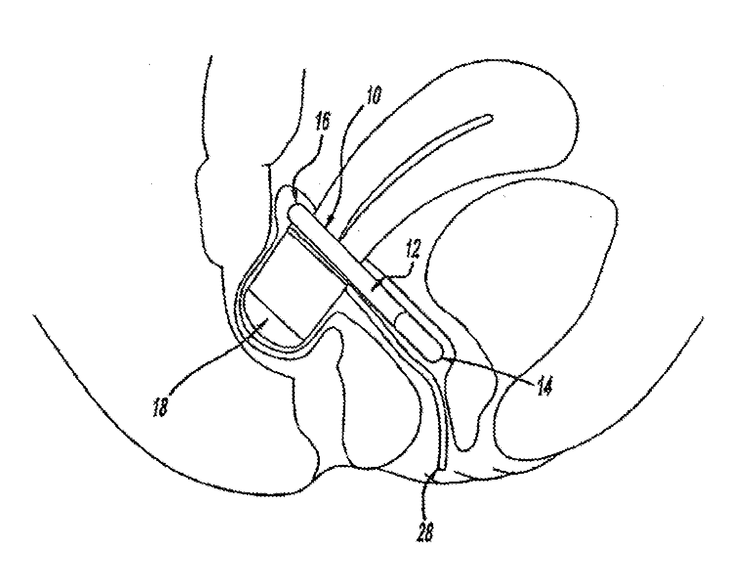 Intra-vaginal devices and methods for treating fecal incontinence