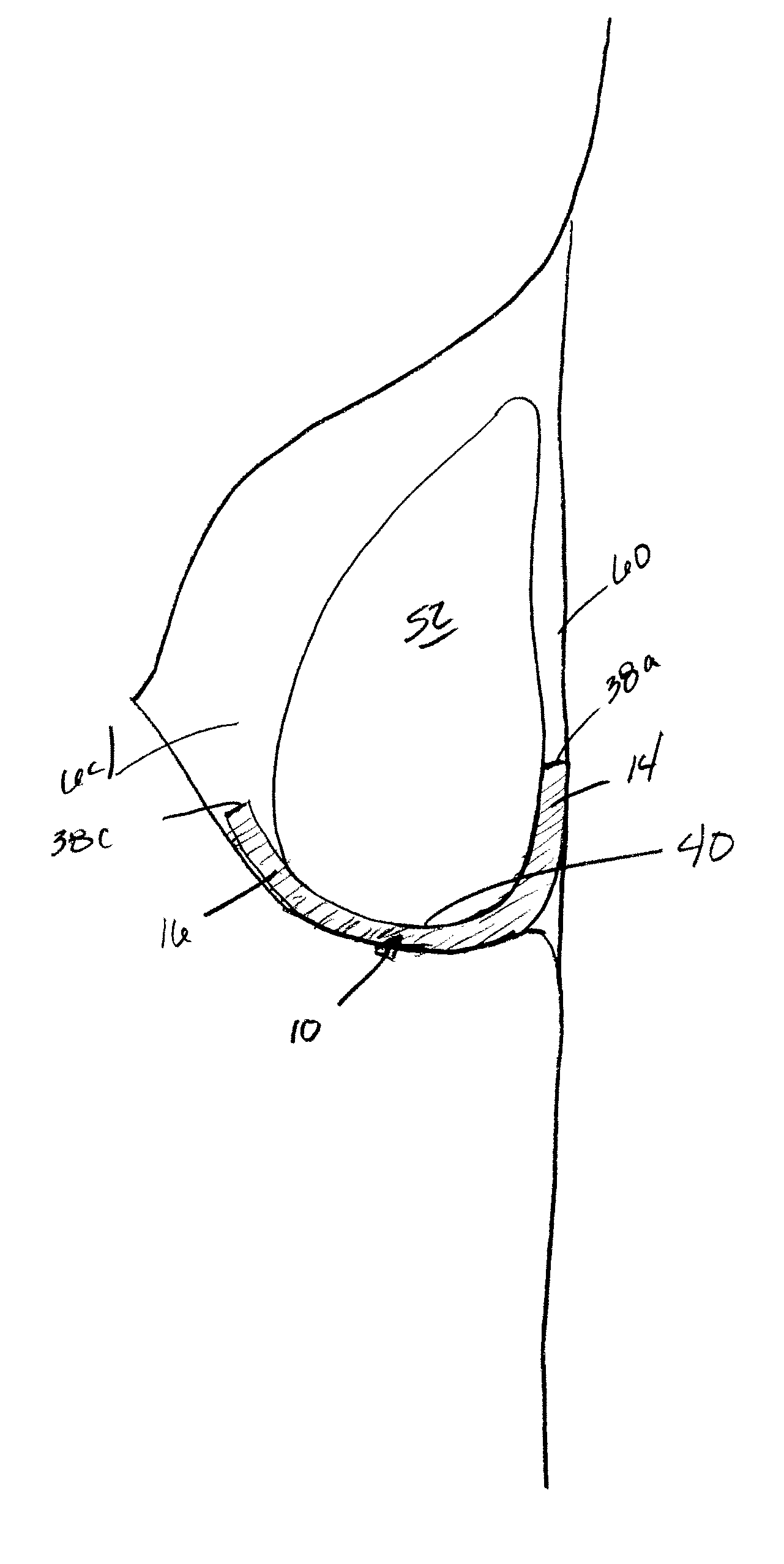 Implantable prosthesis for positioning and supporting a breast implant