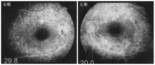 A pathogenic mutation of hereditary usher syndrome and its detection reagent