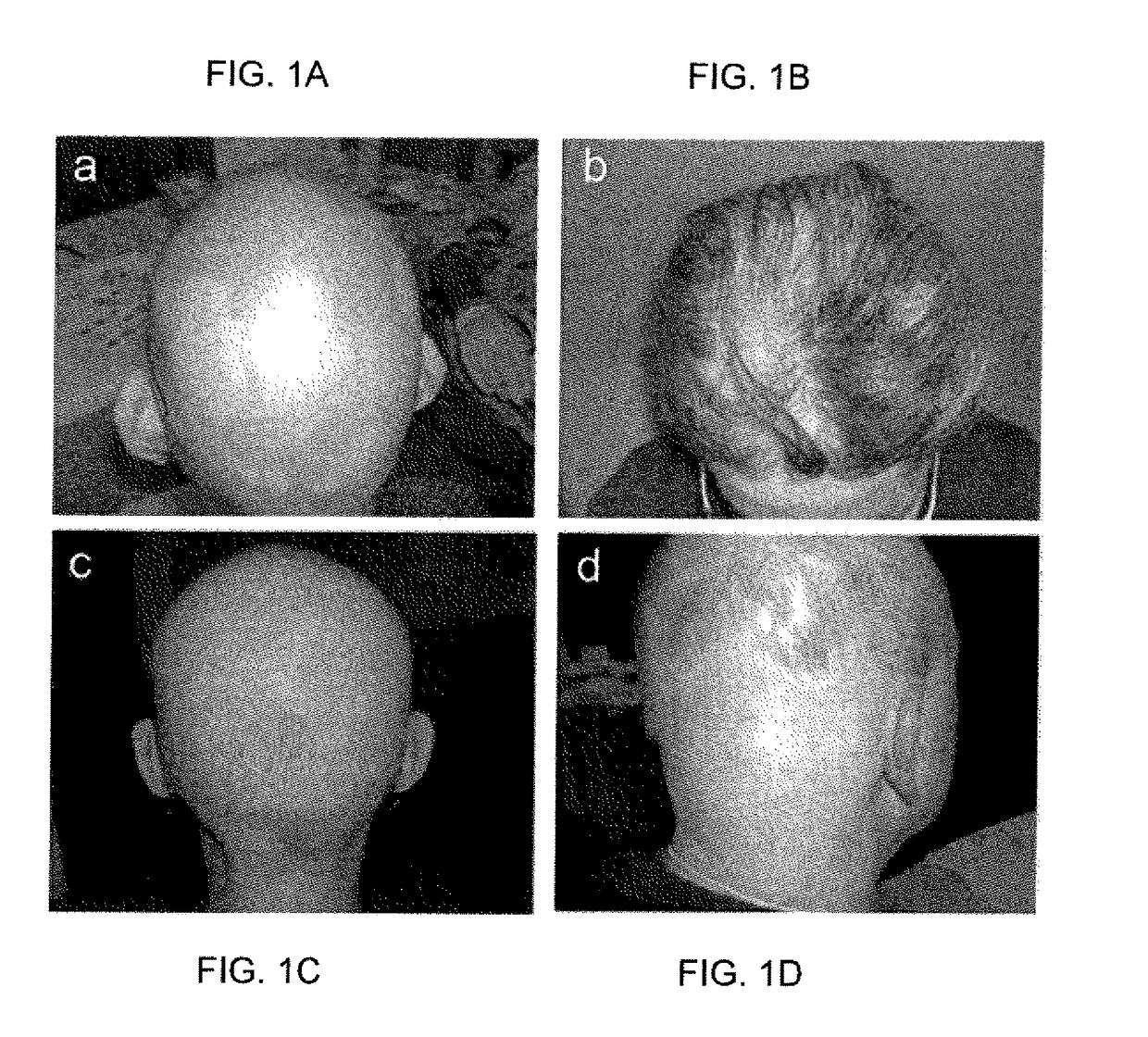 Methods for treating hair loss disorders